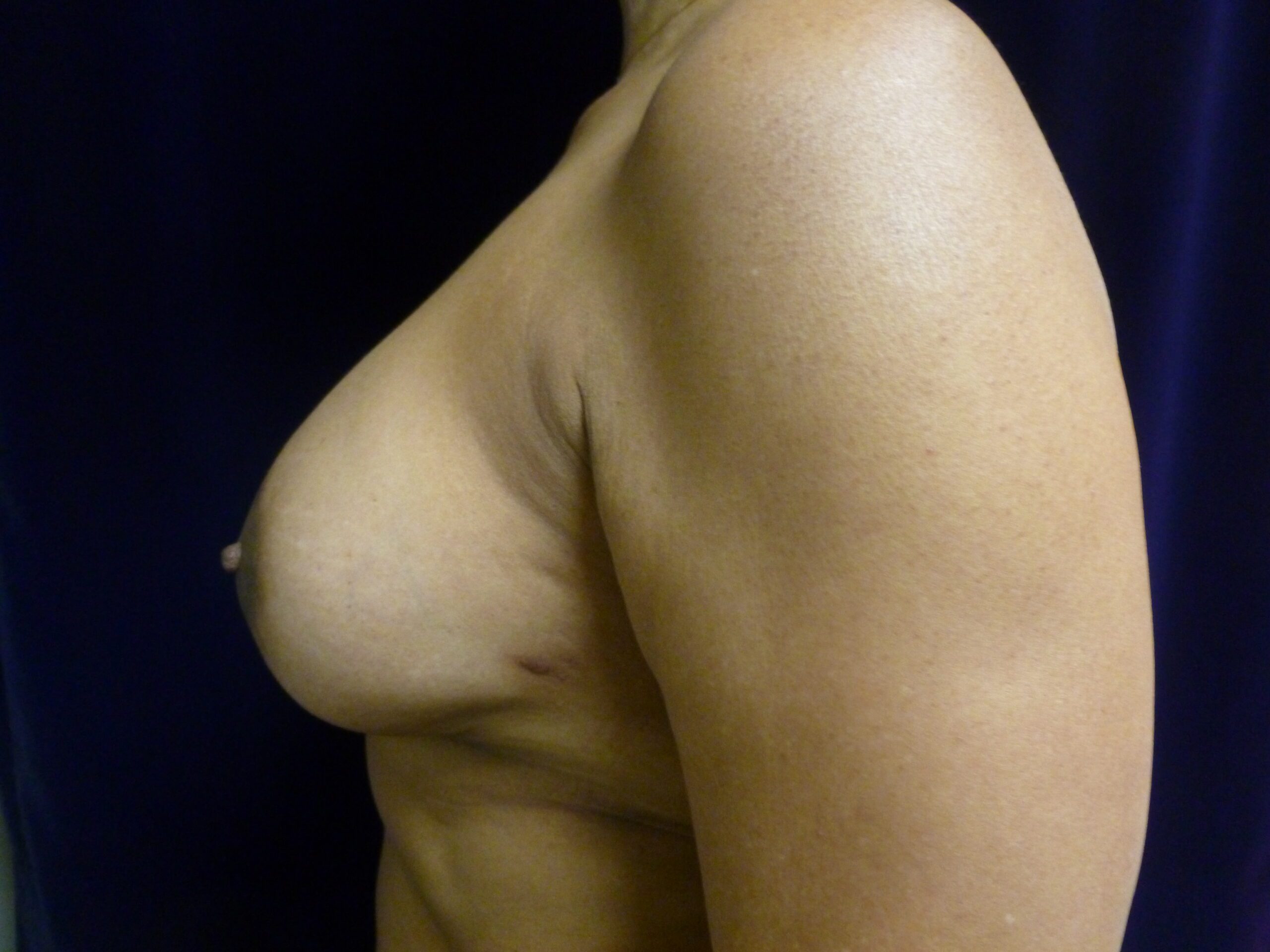 Breast Augmentation Patient Photo - Case 2010 - before view-4