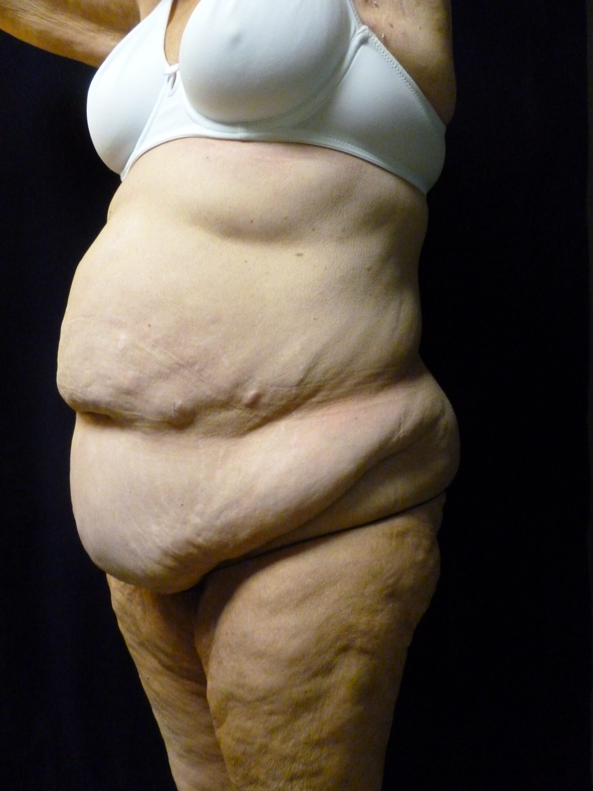Tummy Tuck Patient Photo - Case 2021 - before view-2