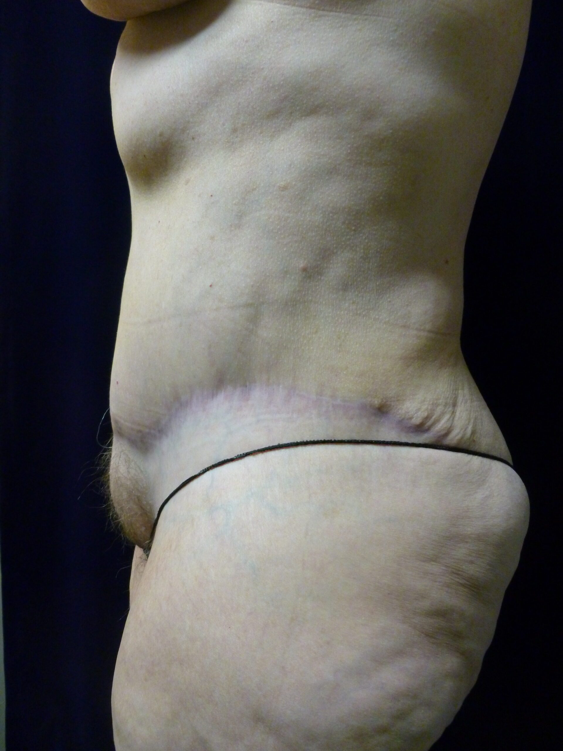 Tummy Tuck Patient Photo - Case 2021 - after view-1