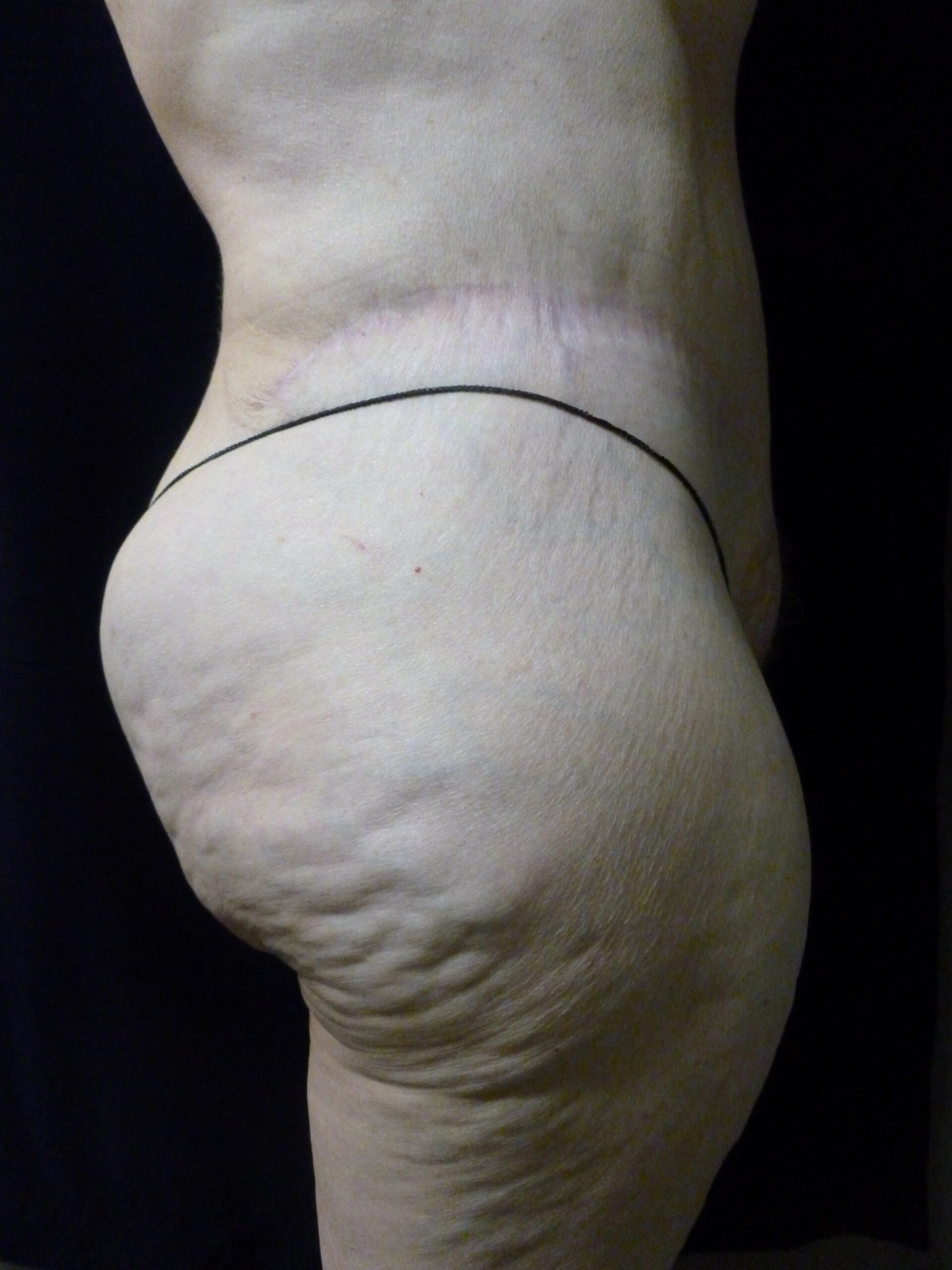 Tummy Tuck Patient Photo - Case 2021 - after view-3