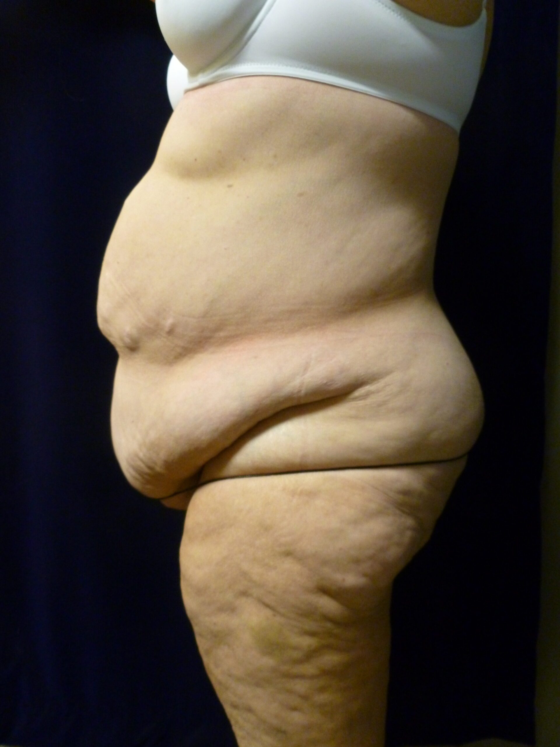 Tummy Tuck Patient Photo - Case 2021 - before view-1