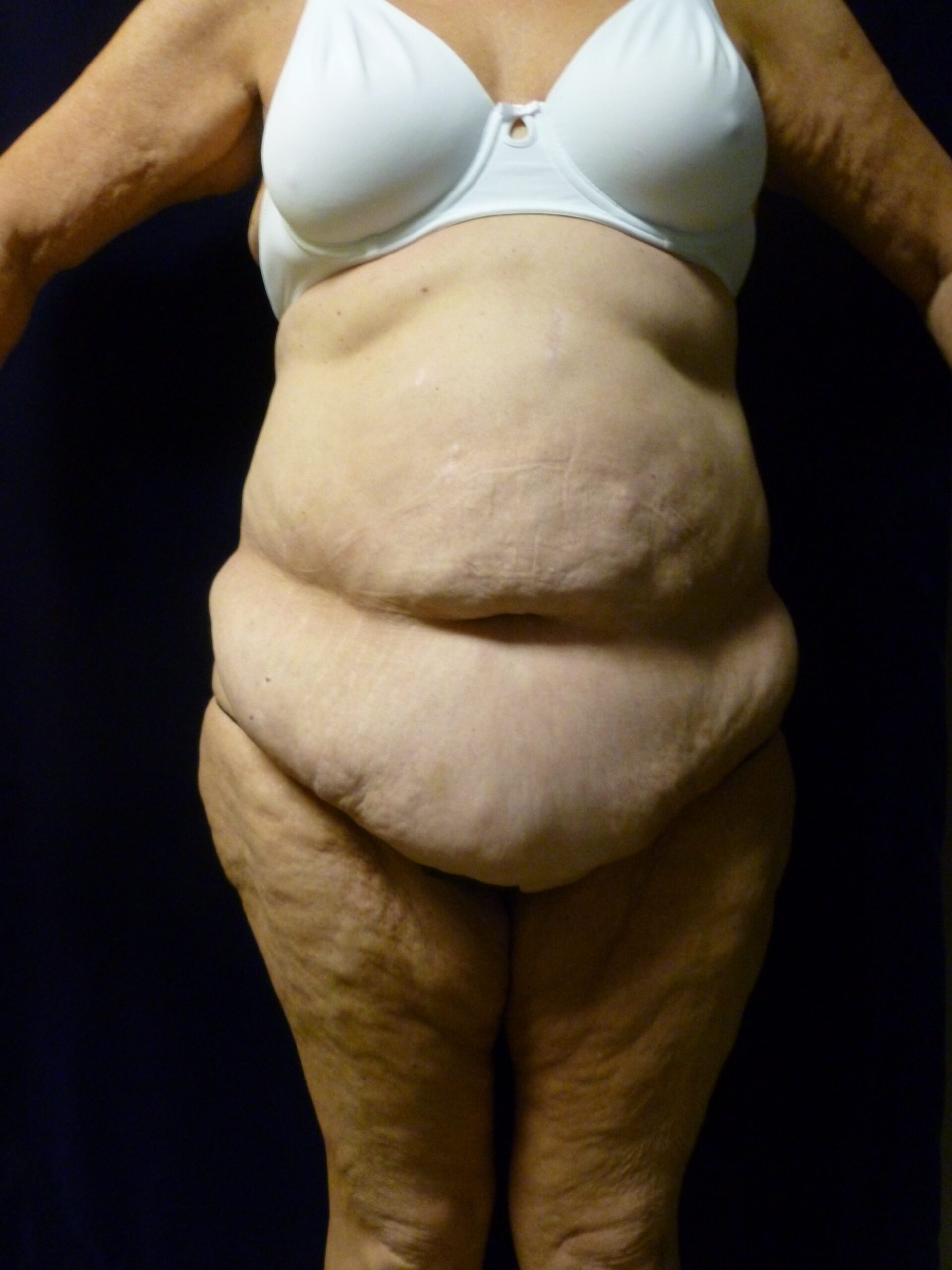 Tummy Tuck Patient Photo - Case 2021 - before view-0