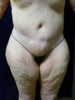 Tummy Tuck - Case 2021 - After