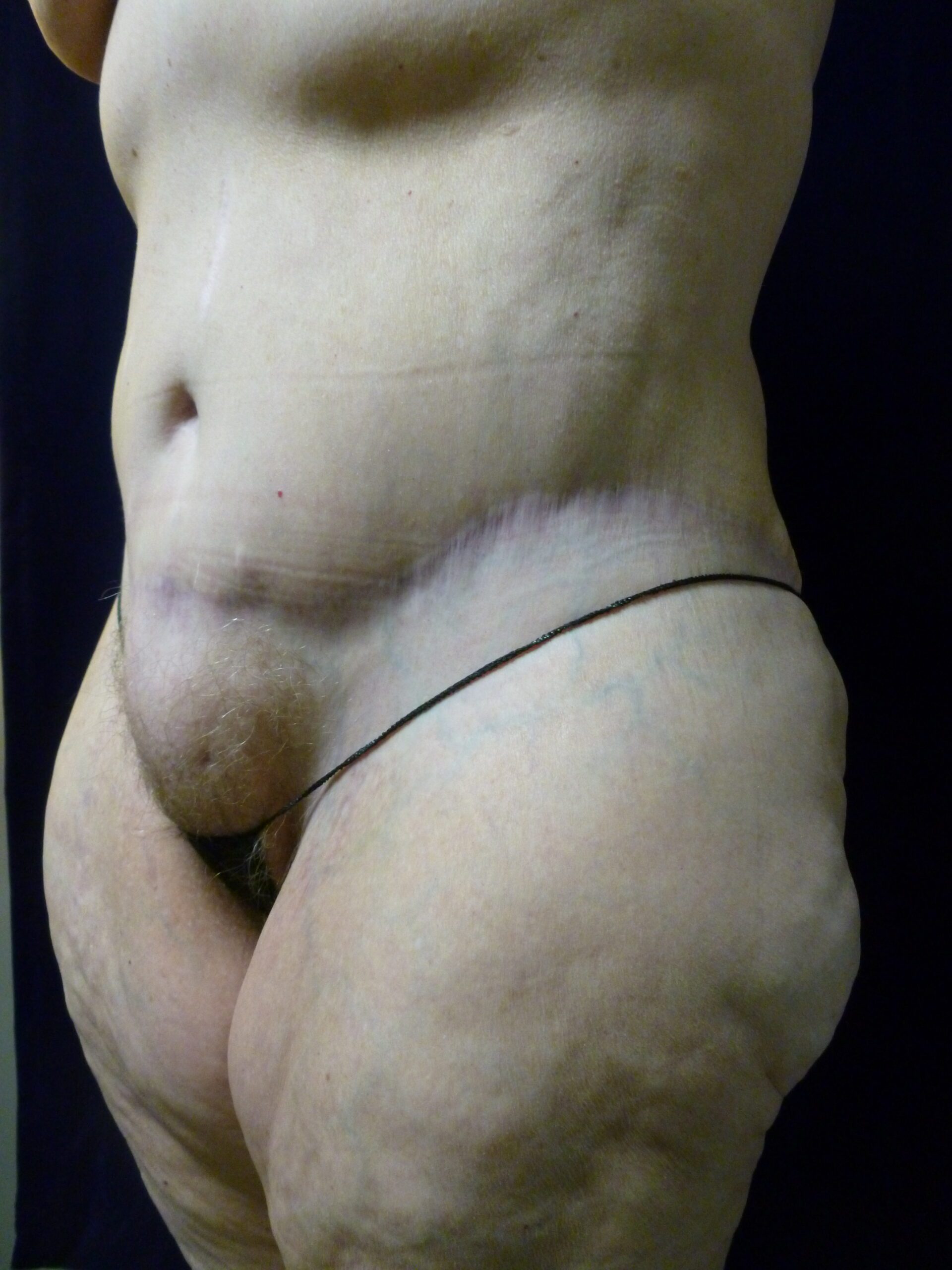 Tummy Tuck Patient Photo - Case 2021 - after view-2