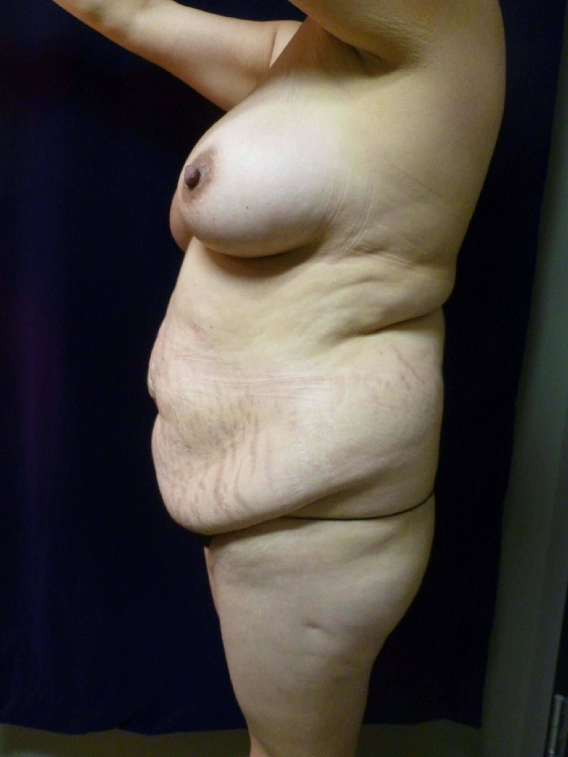 Breast Lift Patient Photo - Case 2137 - before view-1