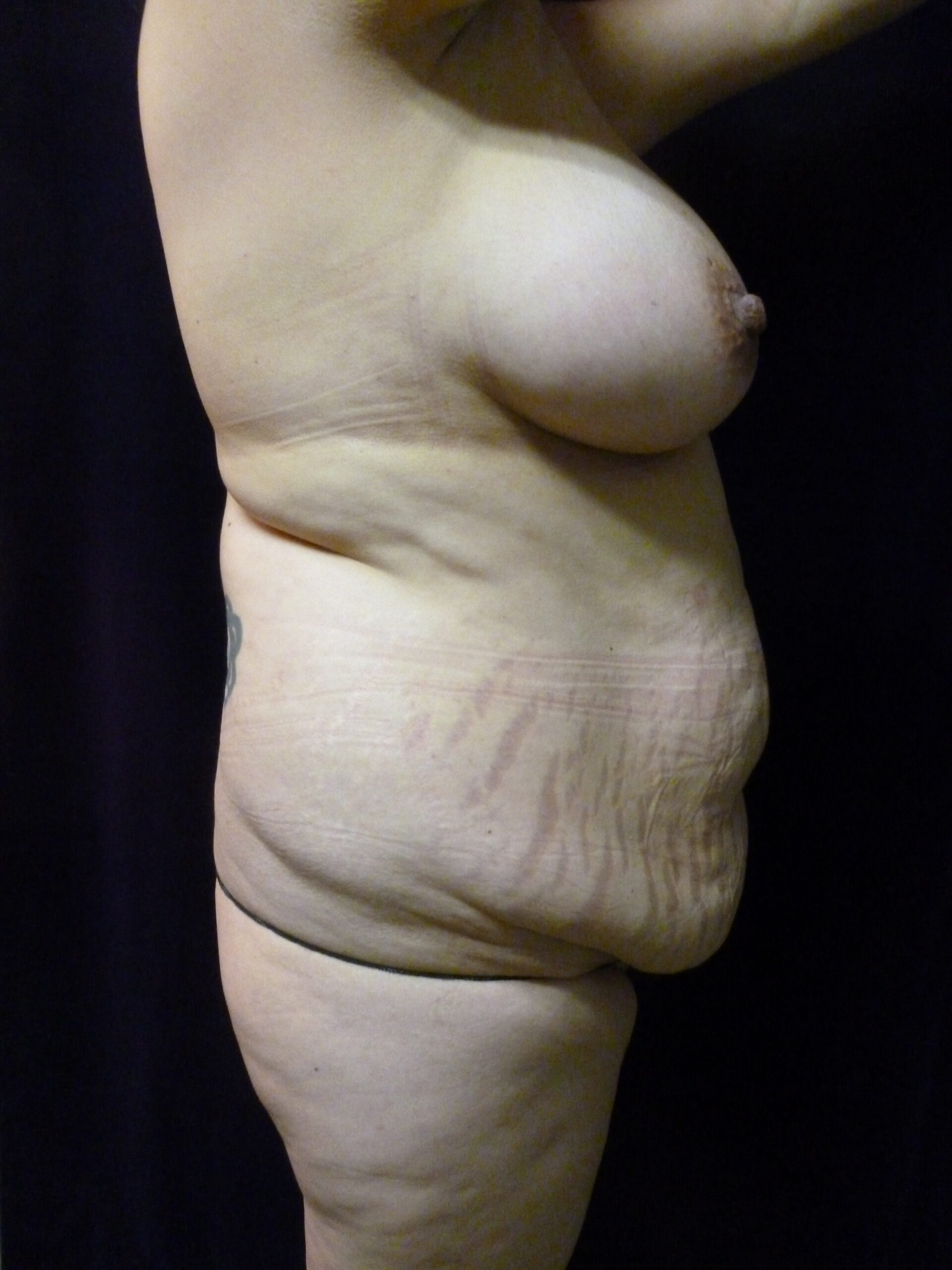 Breast Lift Patient Photo - Case 2137 - before view-2