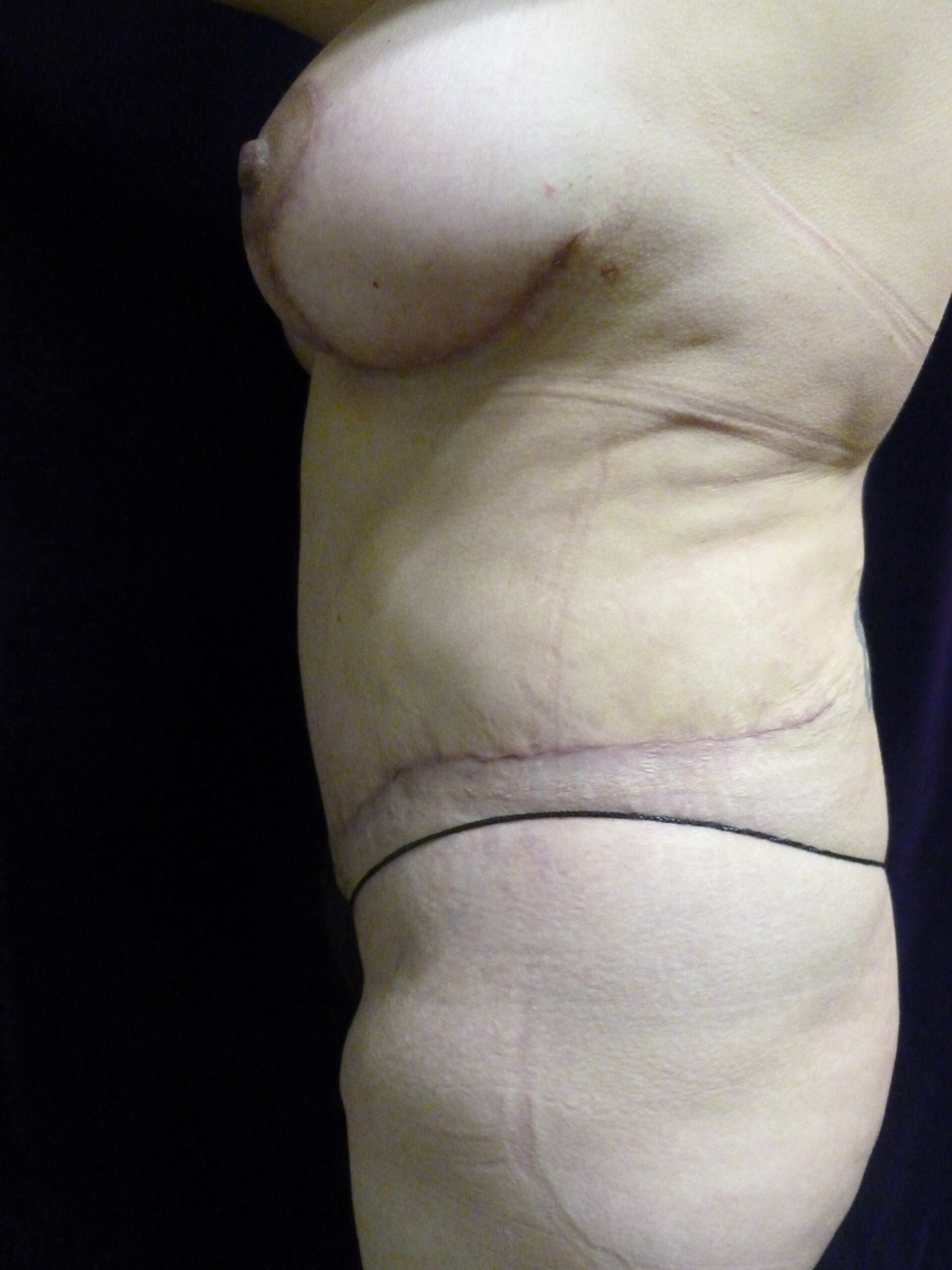 Breast Lift Patient Photo - Case 2137 - after view-1