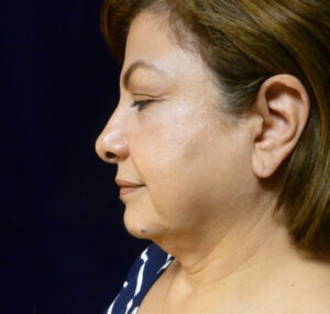 Neck Liposuction - Case 2144 - Before