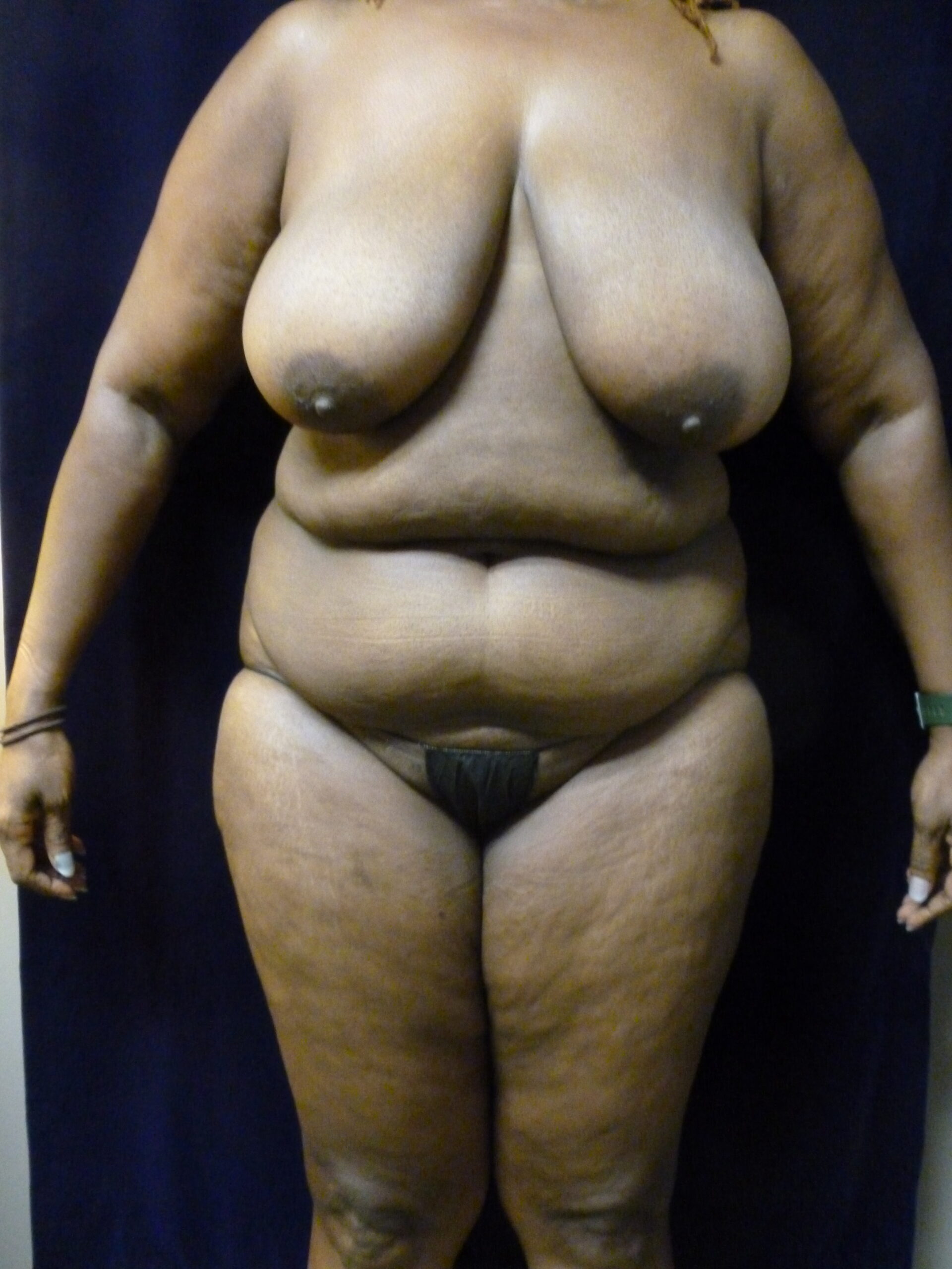 Breast Lift Patient Photo - Case 2147 - before view-
