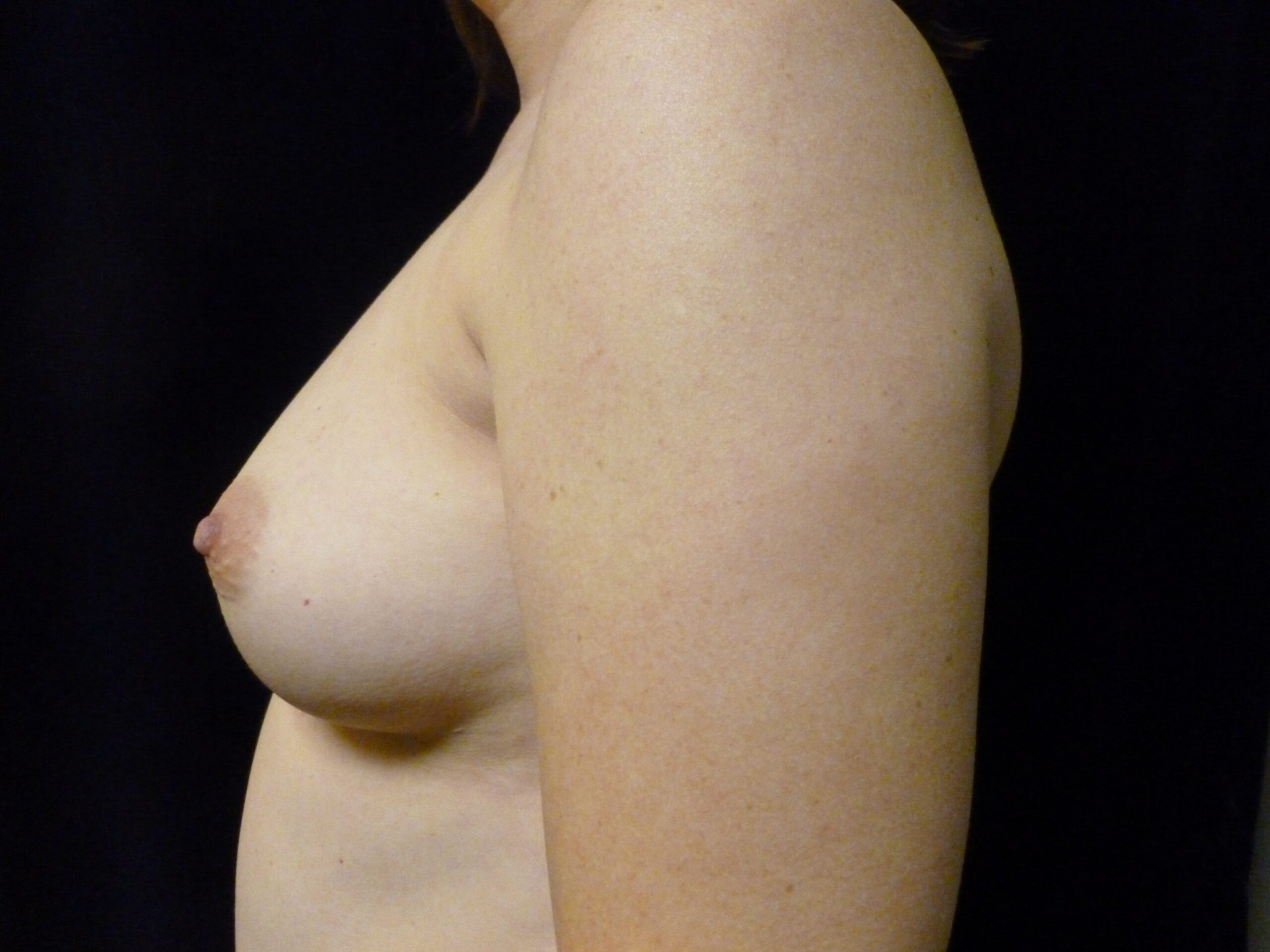 Breast Augmentation Patient Photo - Case 2152 - before view-2