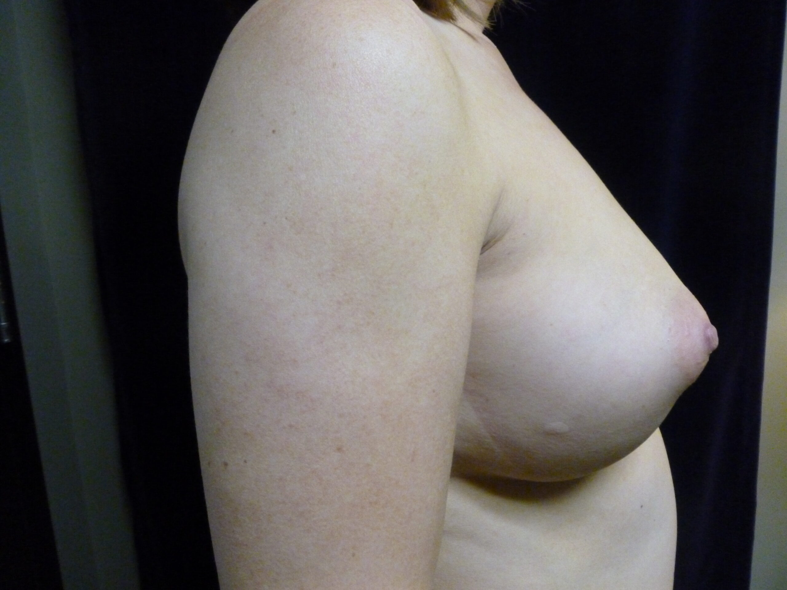 Breast Augmentation Patient Photo - Case 2152 - after view-1