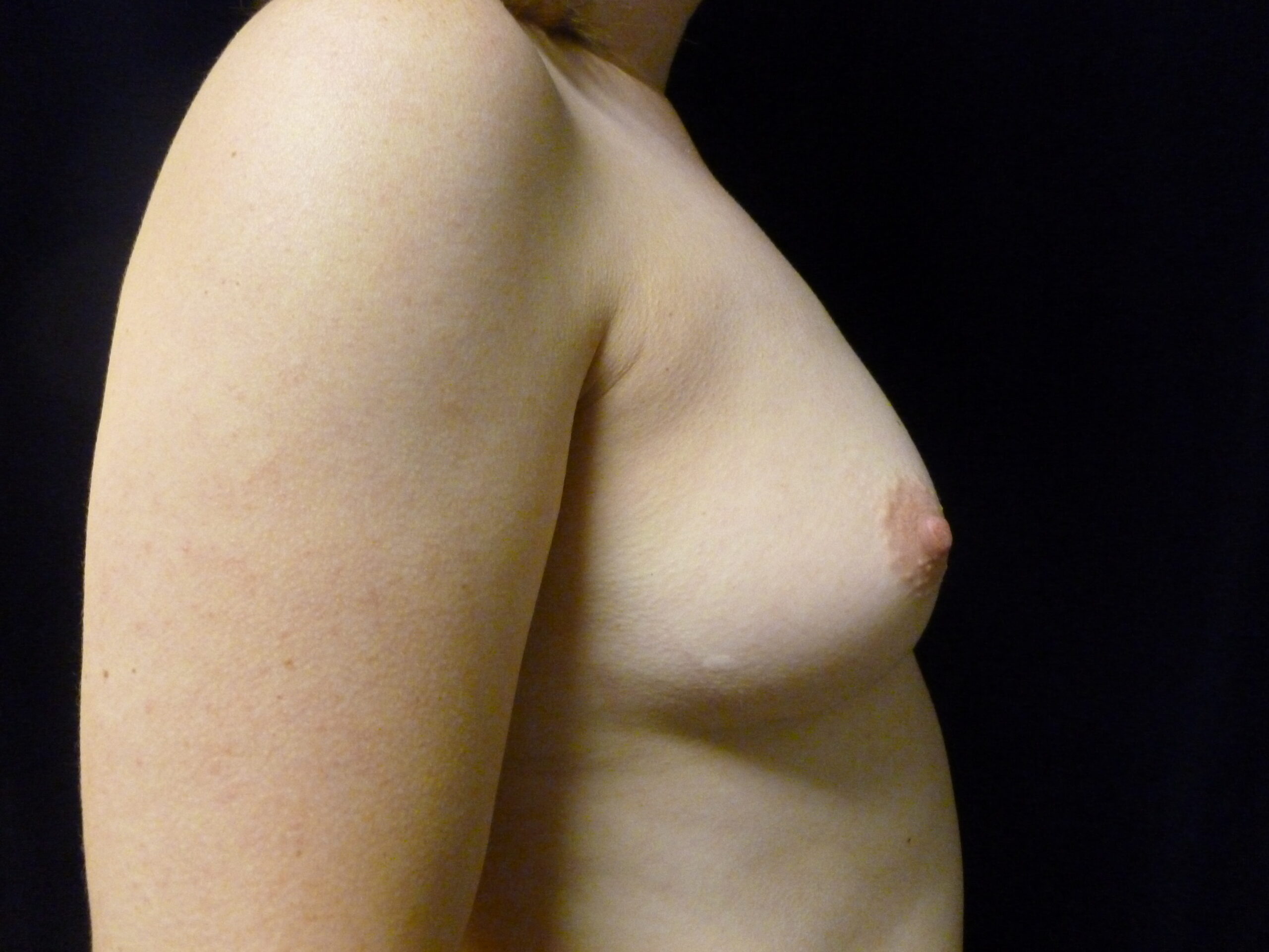 Breast Augmentation Patient Photo - Case 2152 - before view-1