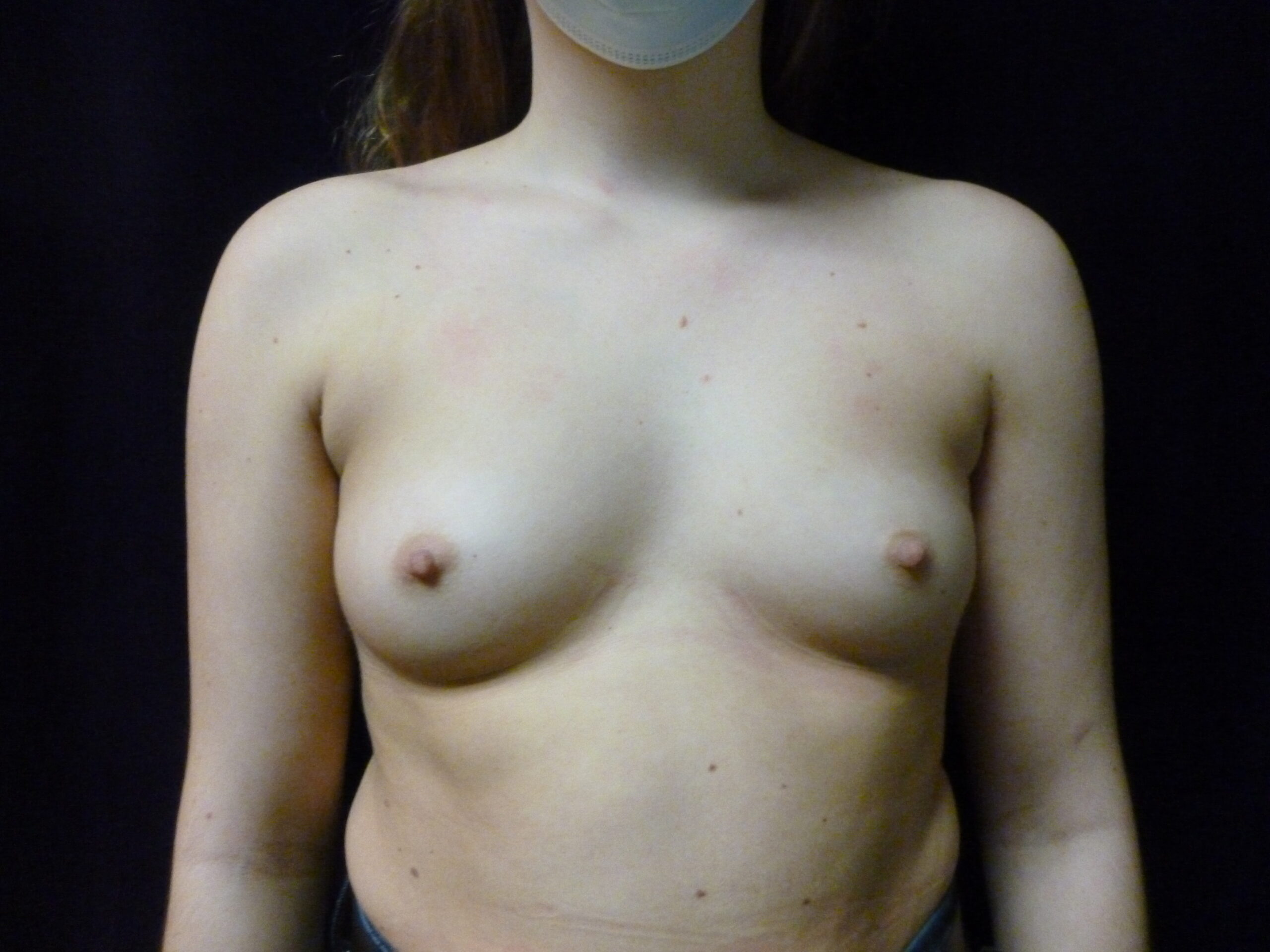 Breast Augmentation Patient Photo - Case 2168 - before view-3