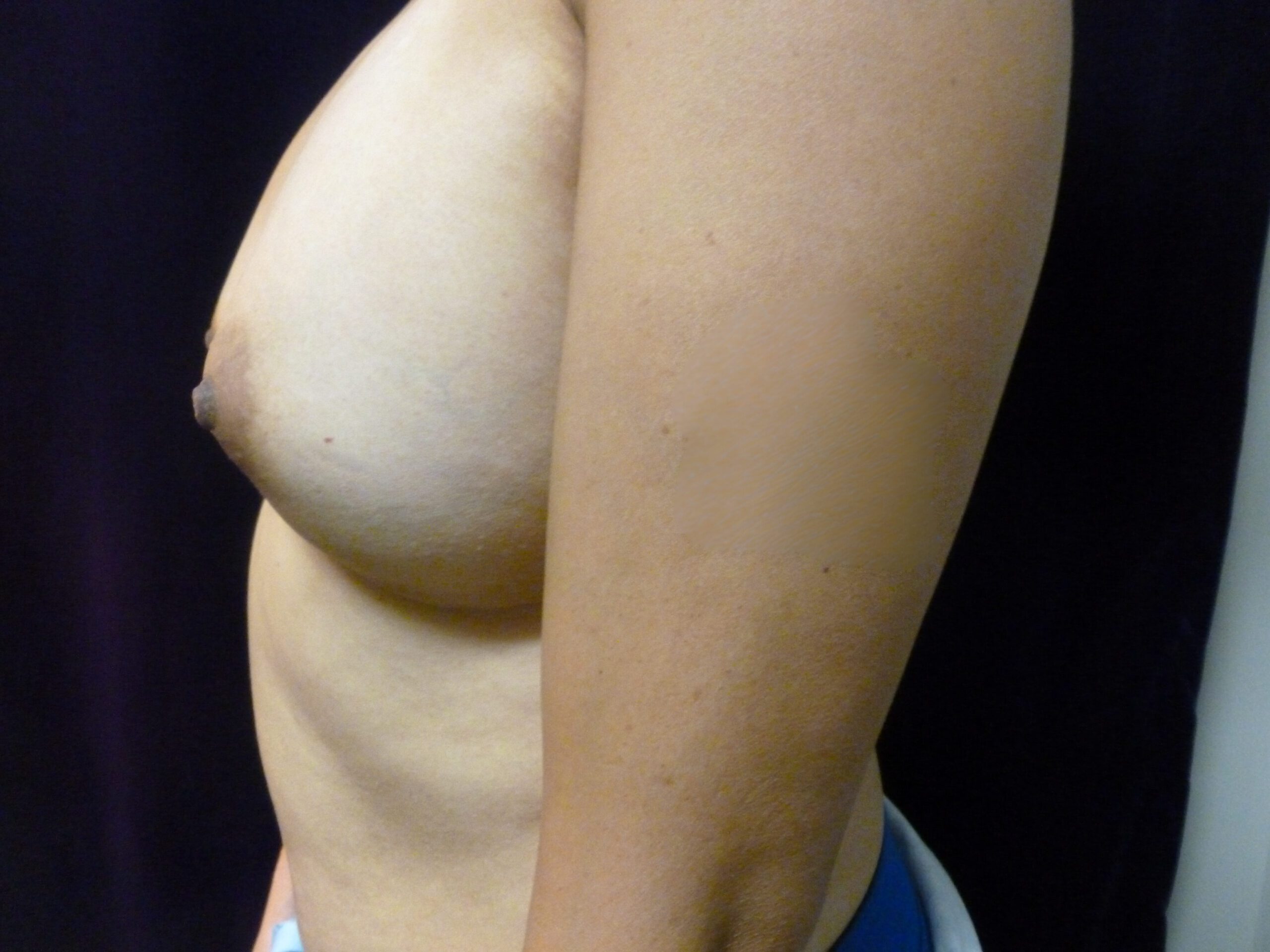 Breast Augmentation Patient Photo - Case 2180 - after view-3