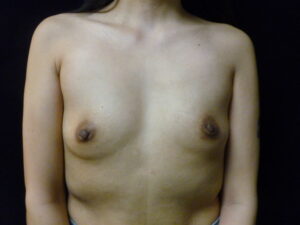 Breast Augmentation - Case 2180 - Before