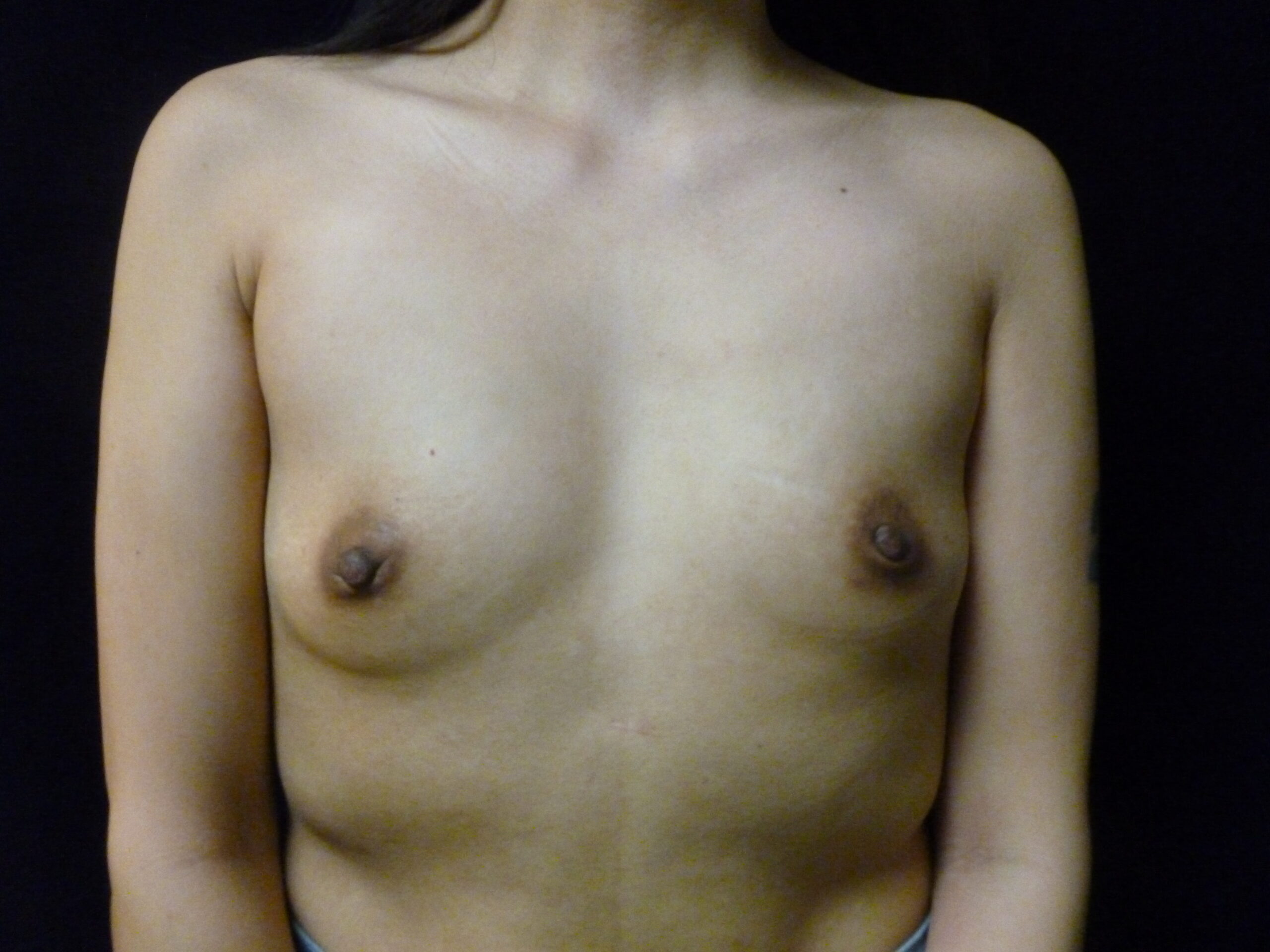 Breast Augmentation Patient Photo - Case 2180 - before view-0