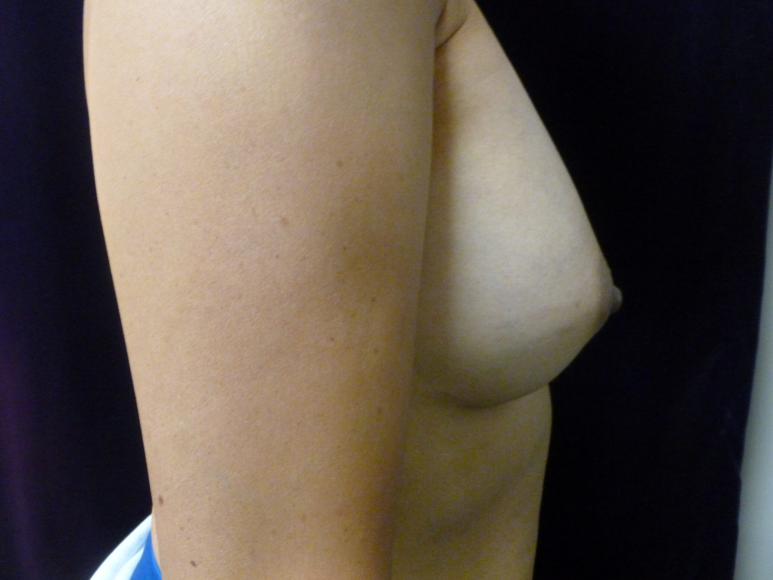Breast Augmentation Patient Photo - Case 2180 - after view-1
