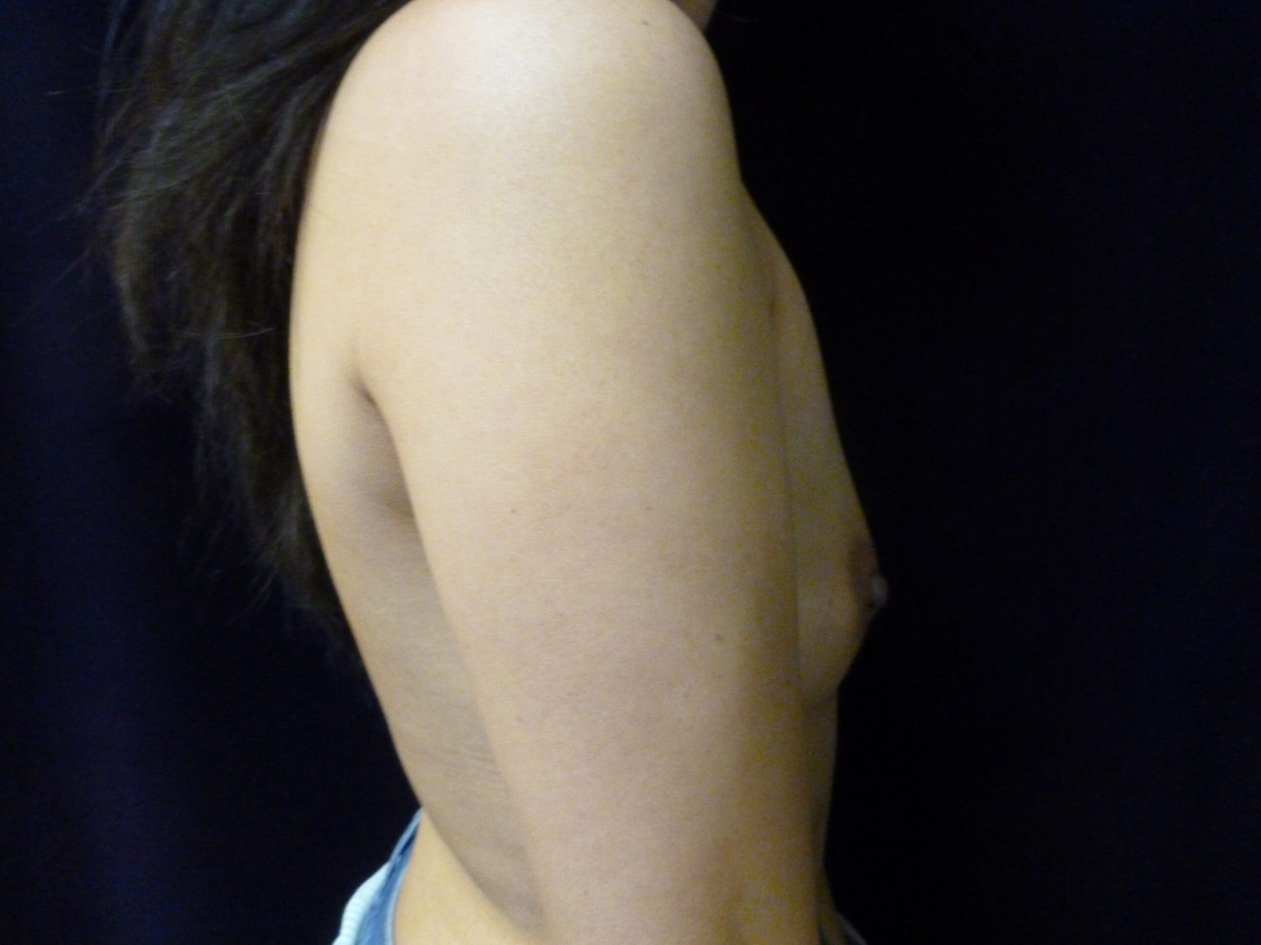 Breast Augmentation Patient Photo - Case 2180 - before view-1
