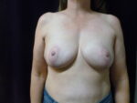 Breast Reduction - Case 2195 - After