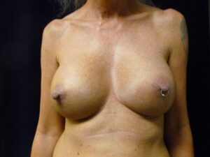 Breast Augmentation - Case 2220 - After