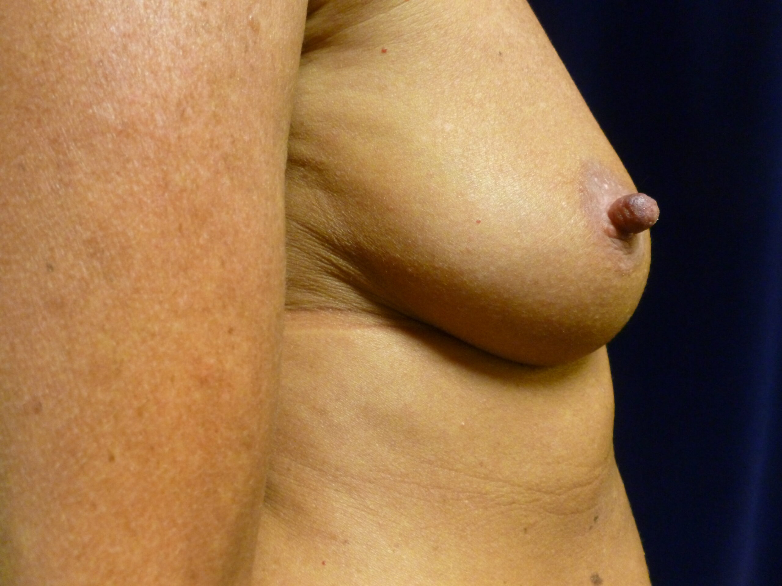 Breast Augmentation Patient Photo - Case 2220 - before view-2