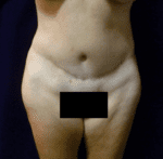 Tummy Tuck - Case 2221 - After