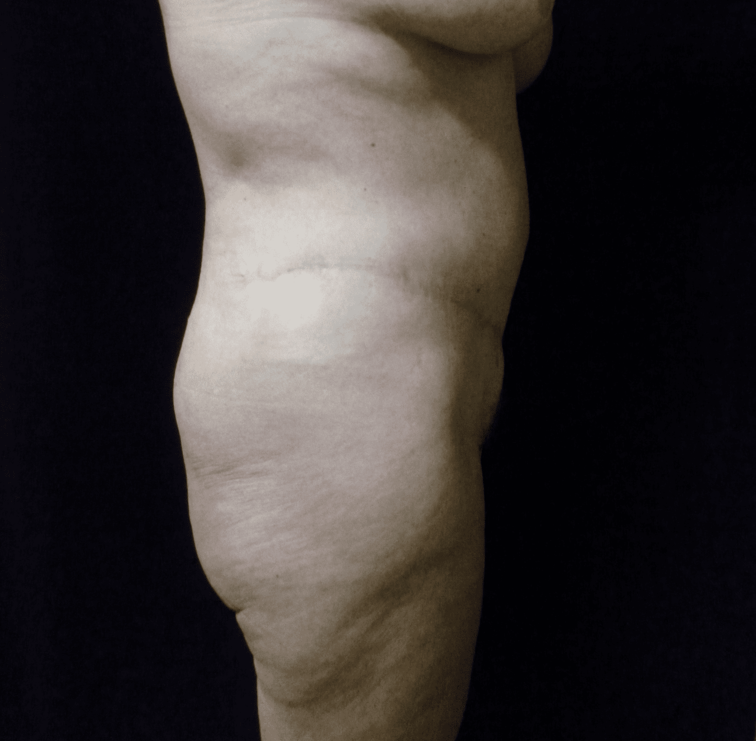 Tummy Tuck Patient Photo - Case 2221 - after view-1