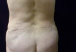 Liposuction - Case 2230 - After