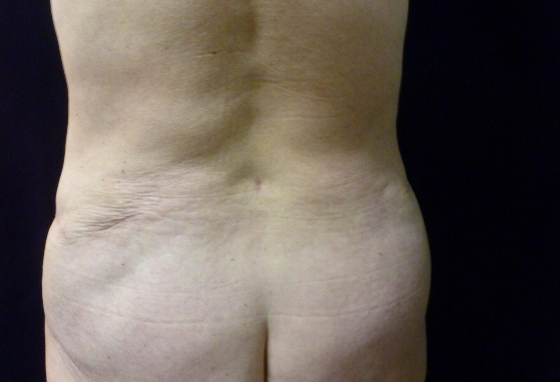 Liposuction Patient Photo - Case 2230 - after view
