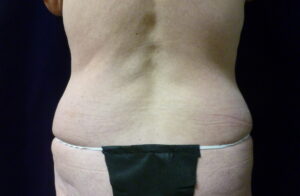 Liposuction - Case 2230 - Before