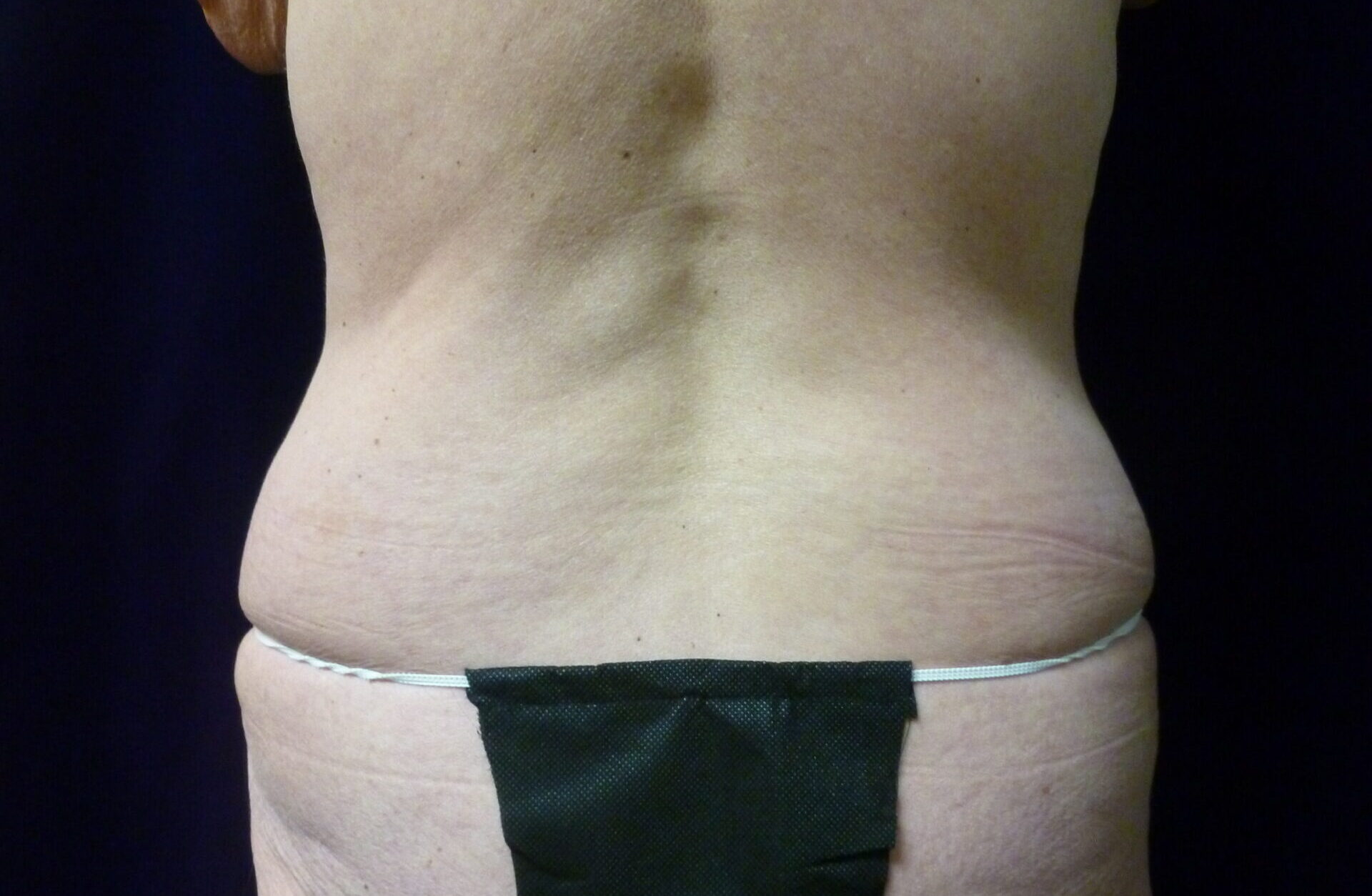 Liposuction Patient Photo - Case 2230 - before view-