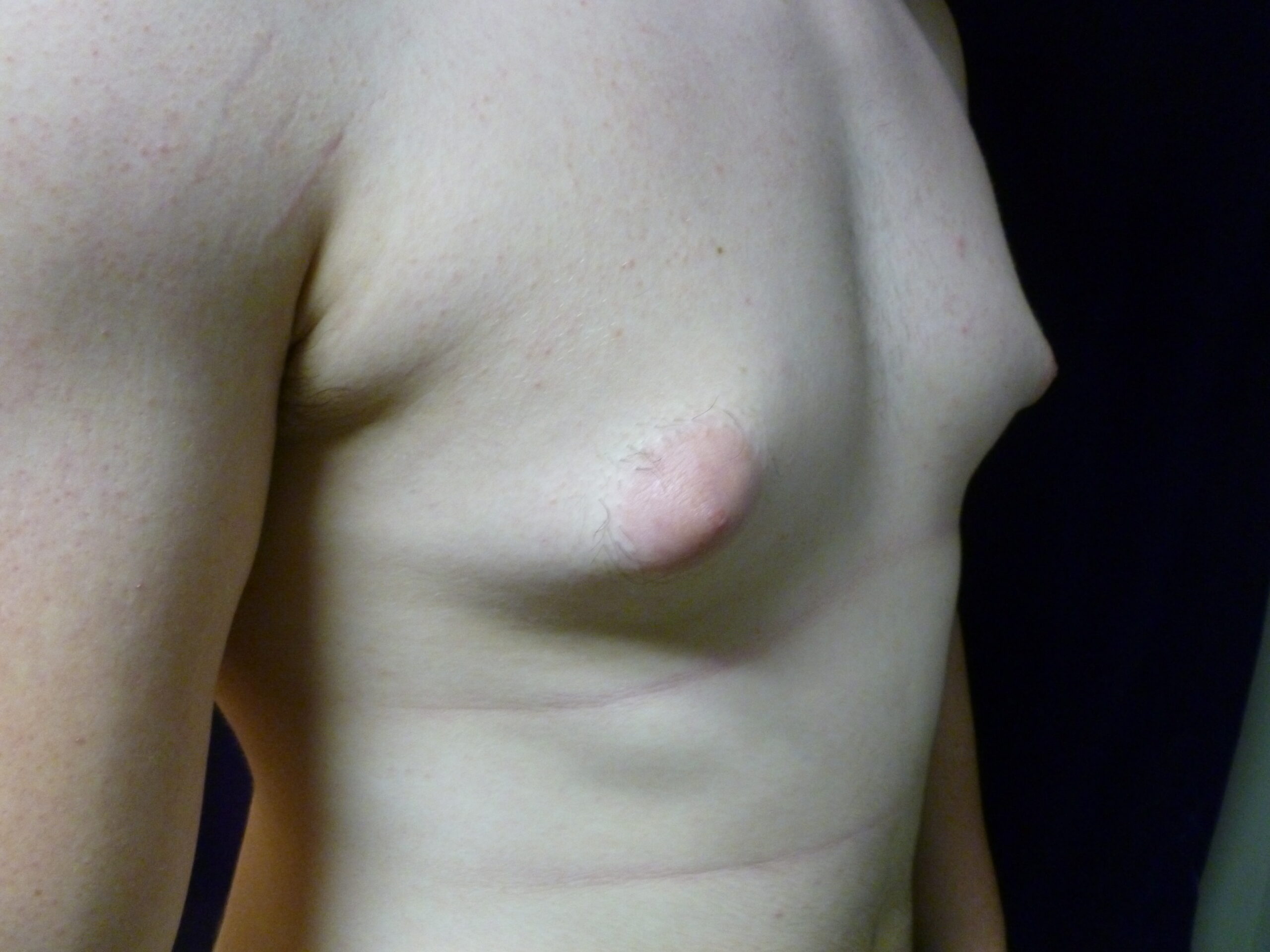 Male Breast Reduction Patient Photo - Case 2233 - before view-1