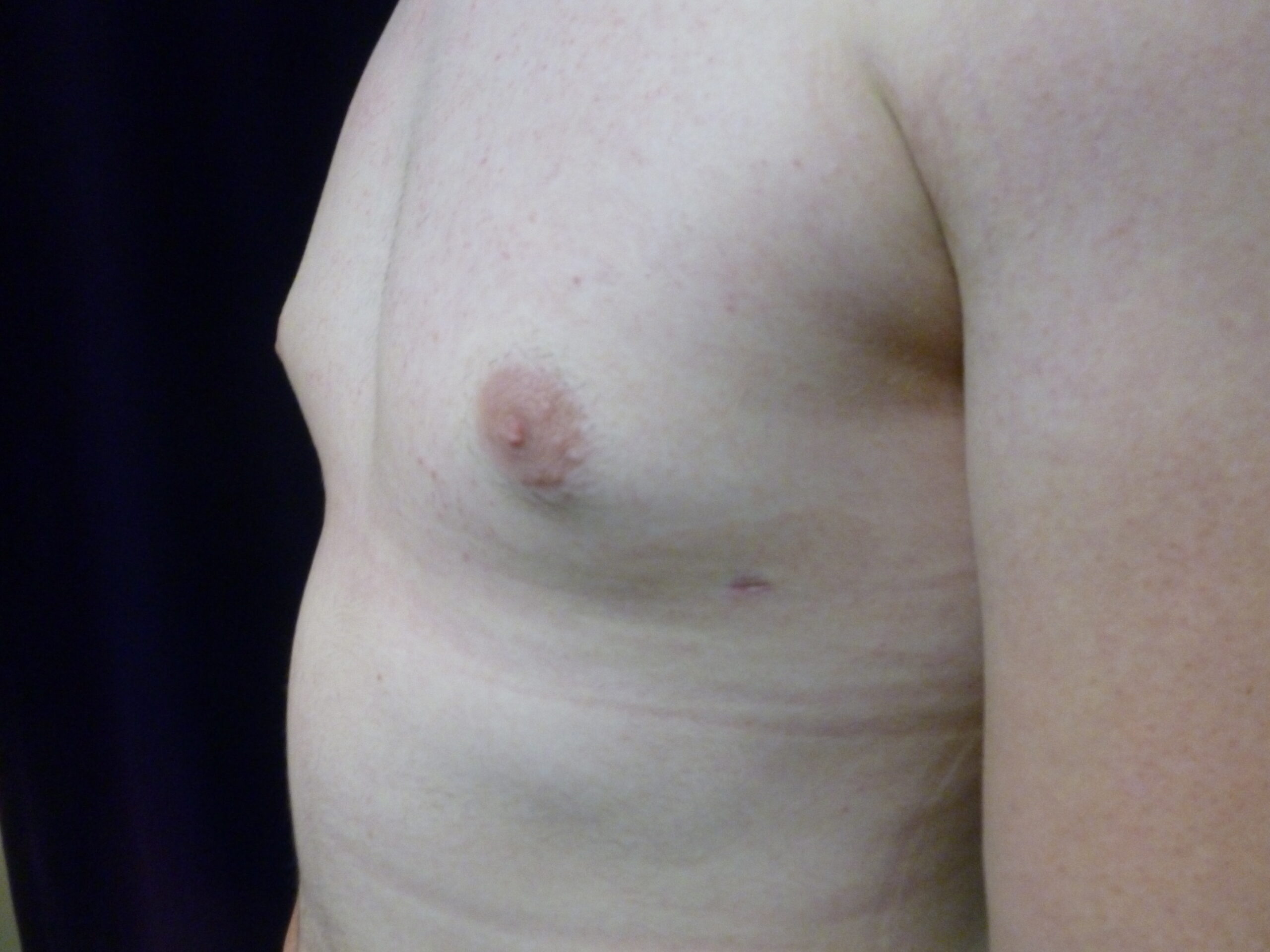 Male Breast Reduction Patient Photo - Case 2233 - after view-2