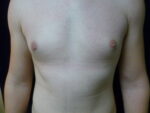 Male Breast Reduction - Case 2233 - After