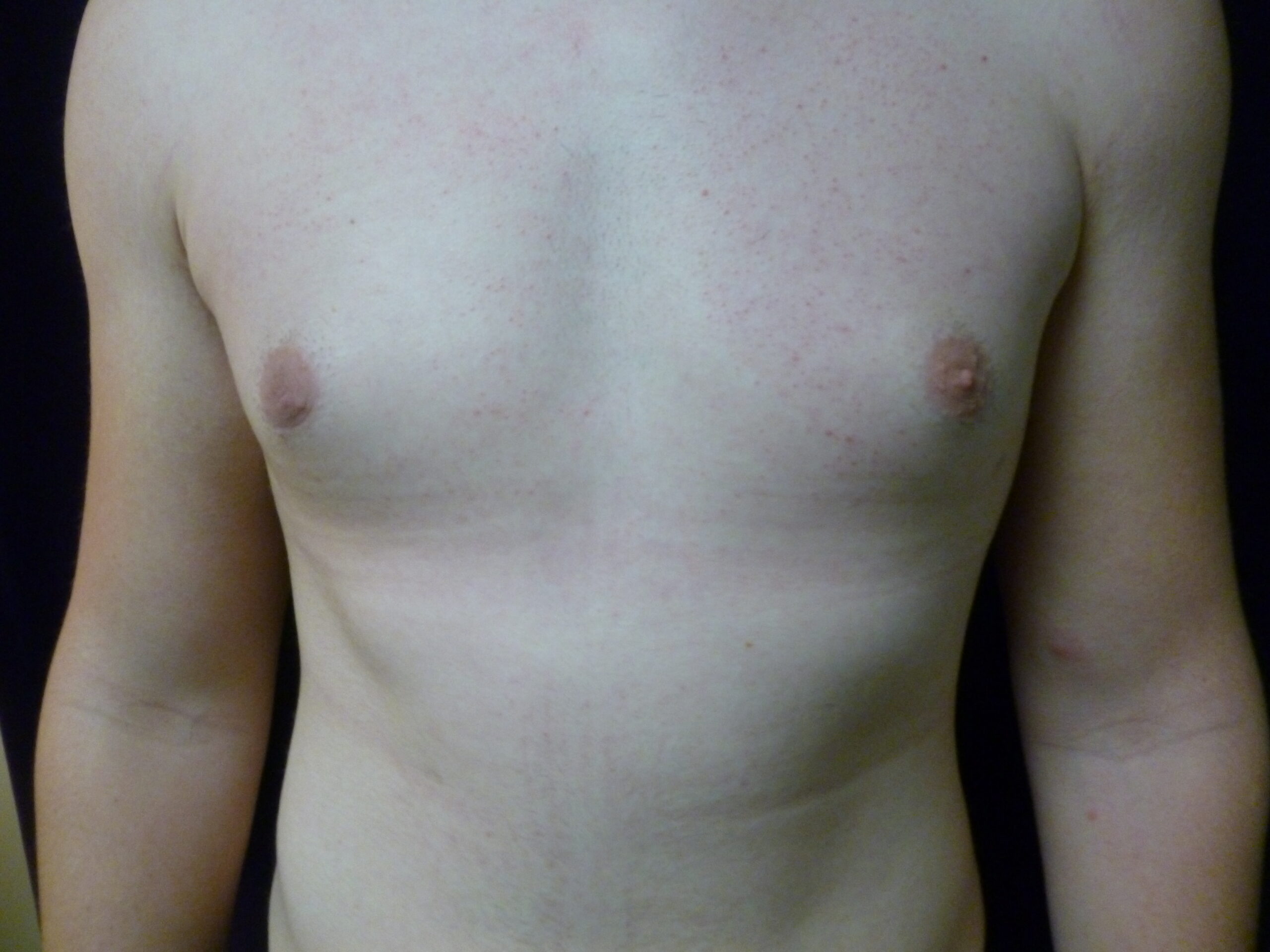 Male Breast Reduction Patient Photo - Case 2233 - after view-0