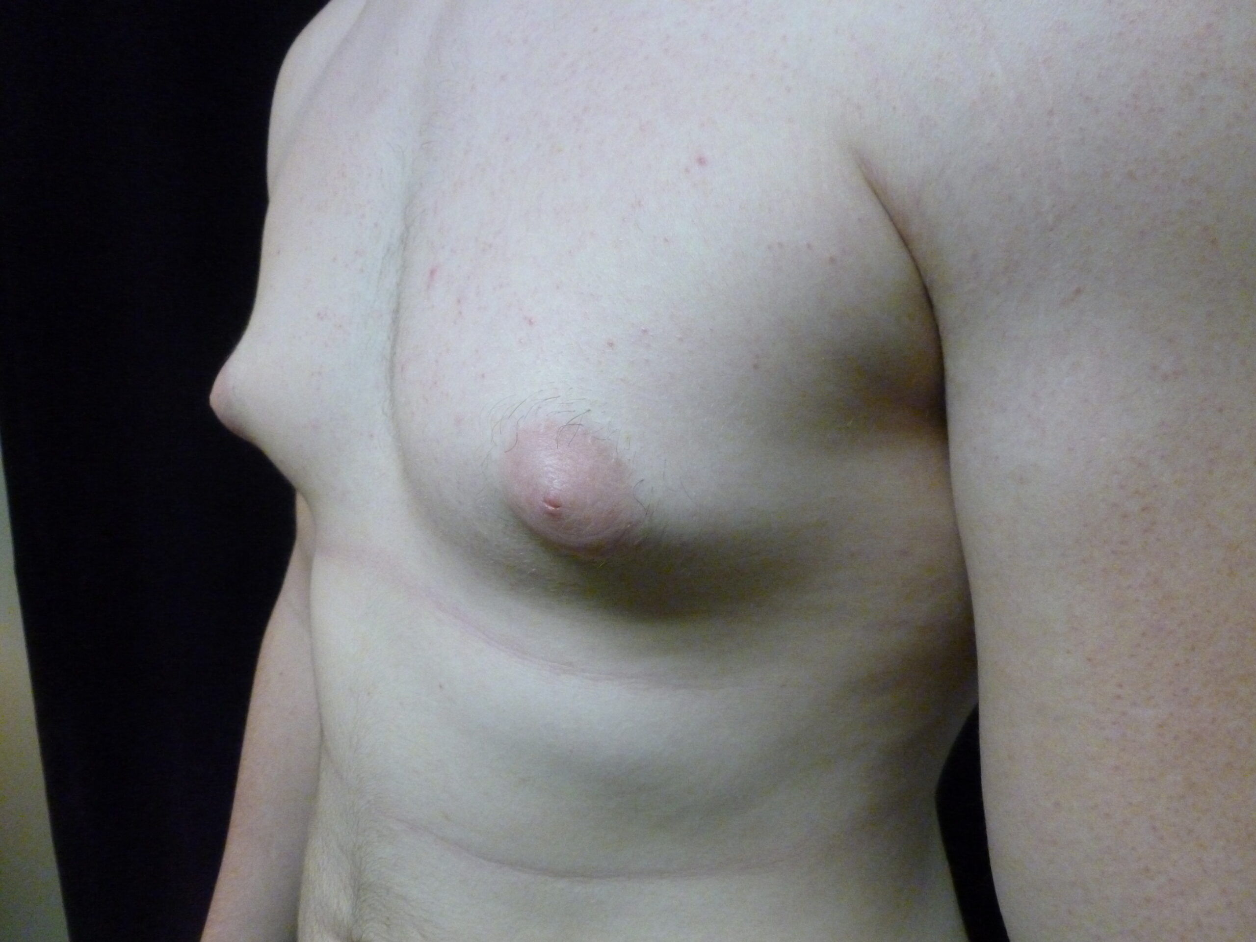 Male Breast Reduction Patient Photo - Case 2233 - before view-2