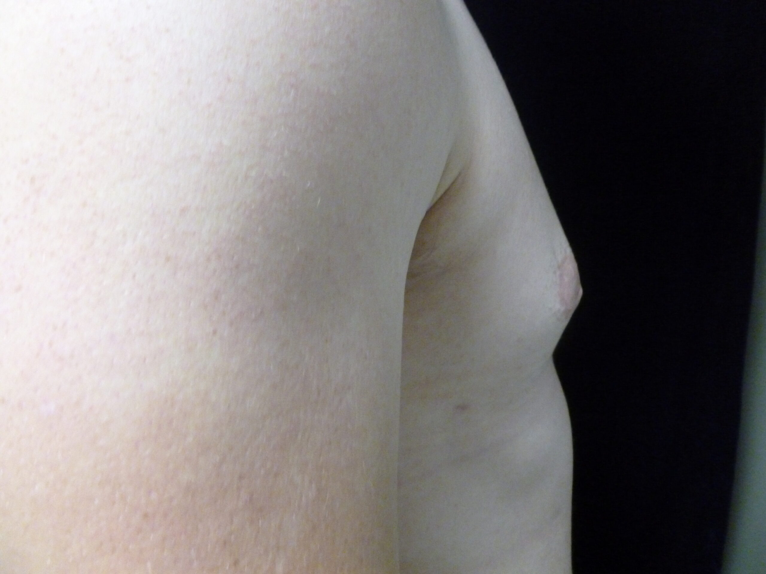 Male Breast Reduction Patient Photo - Case 2233 - after view-3