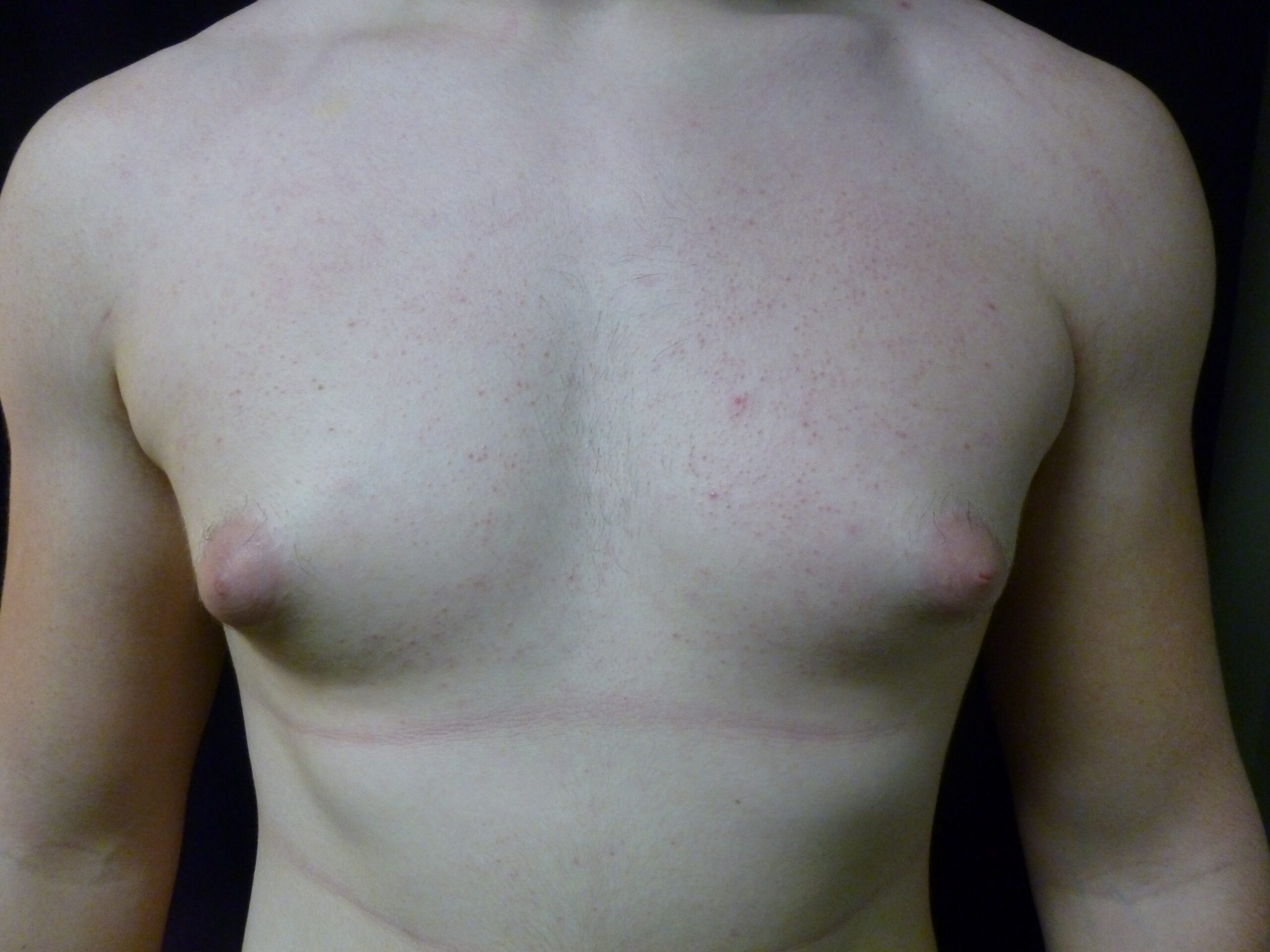 Male Breast Reduction Patient Photo - Case 2233 - before view-