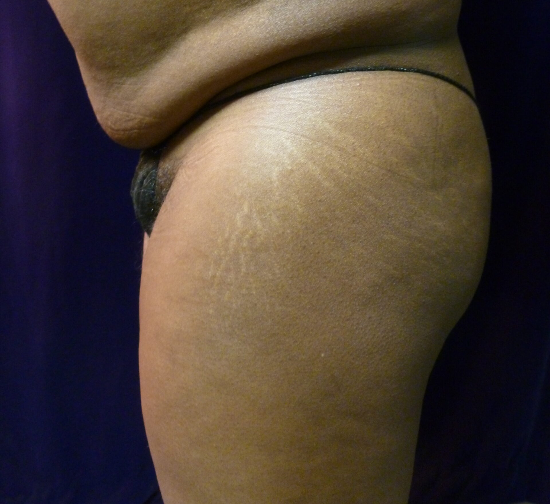 Buttock Lift Patient Photo - Case 2251 - before view-2