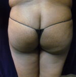Buttock Lift - Case 2251 - Before