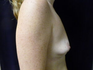 Breast Augmentation - Case 2252 - Before