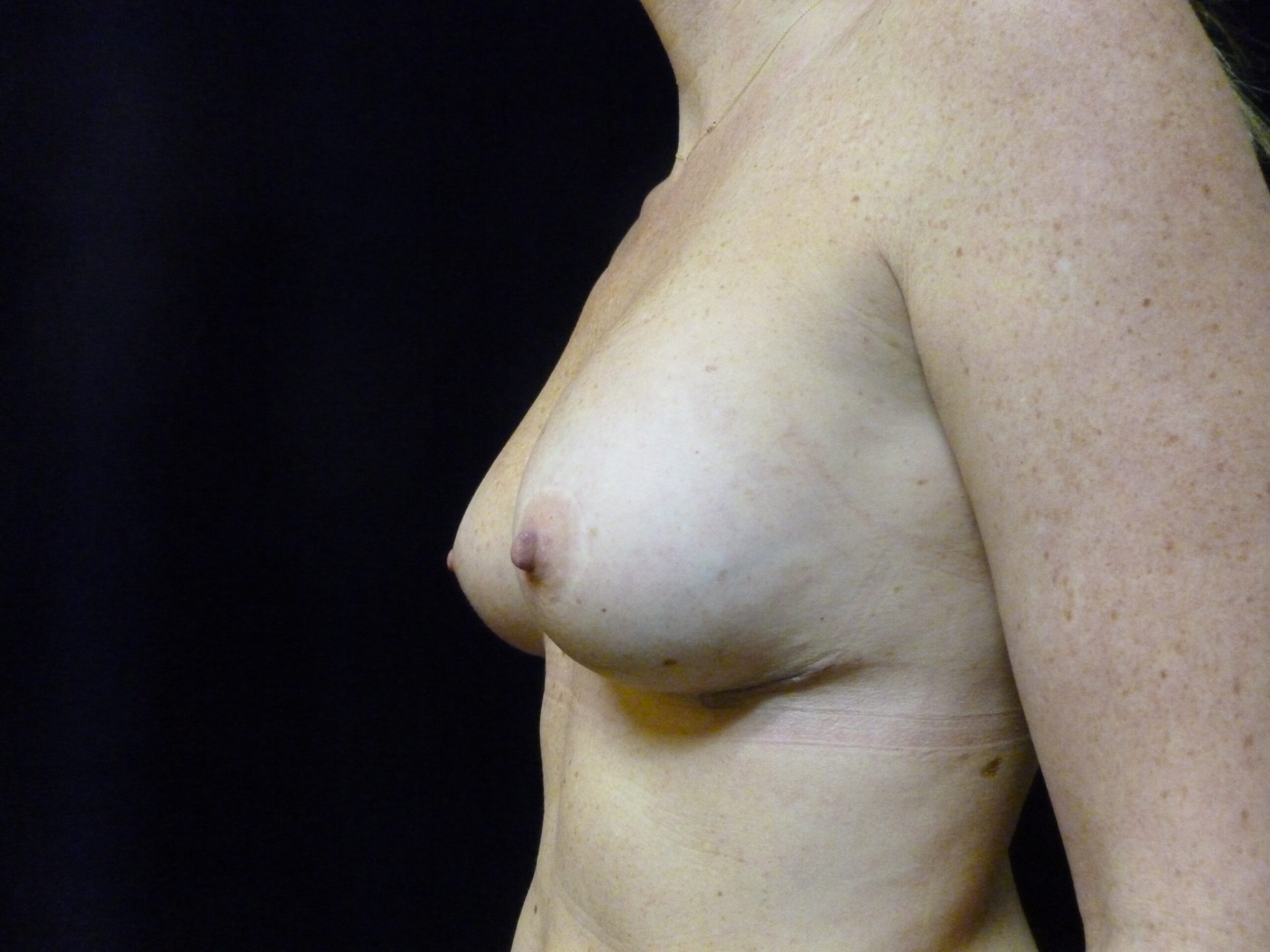 Breast Augmentation Patient Photo - Case 2252 - after view-3