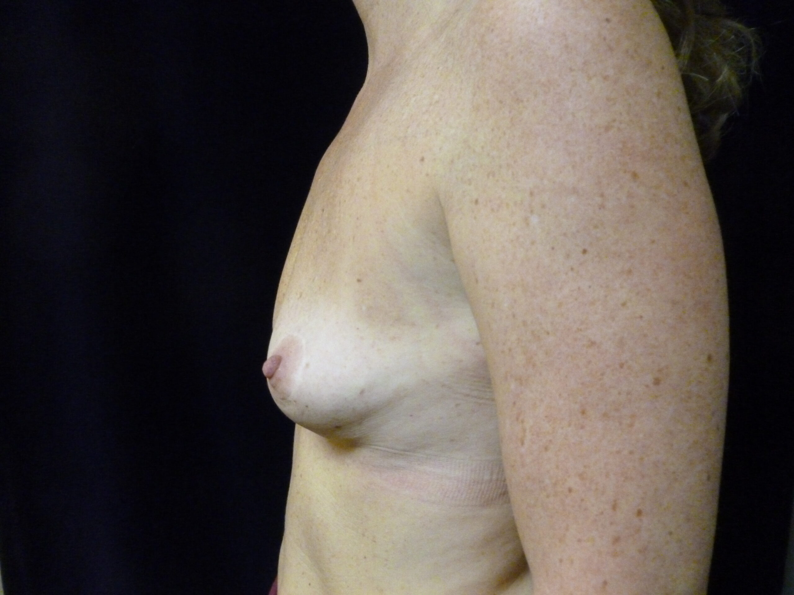 Breast Augmentation Patient Photo - Case 2252 - before view-3
