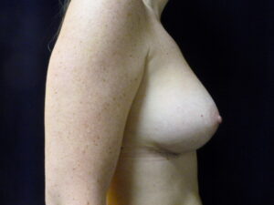 Breast Augmentation - Case 2252 - After