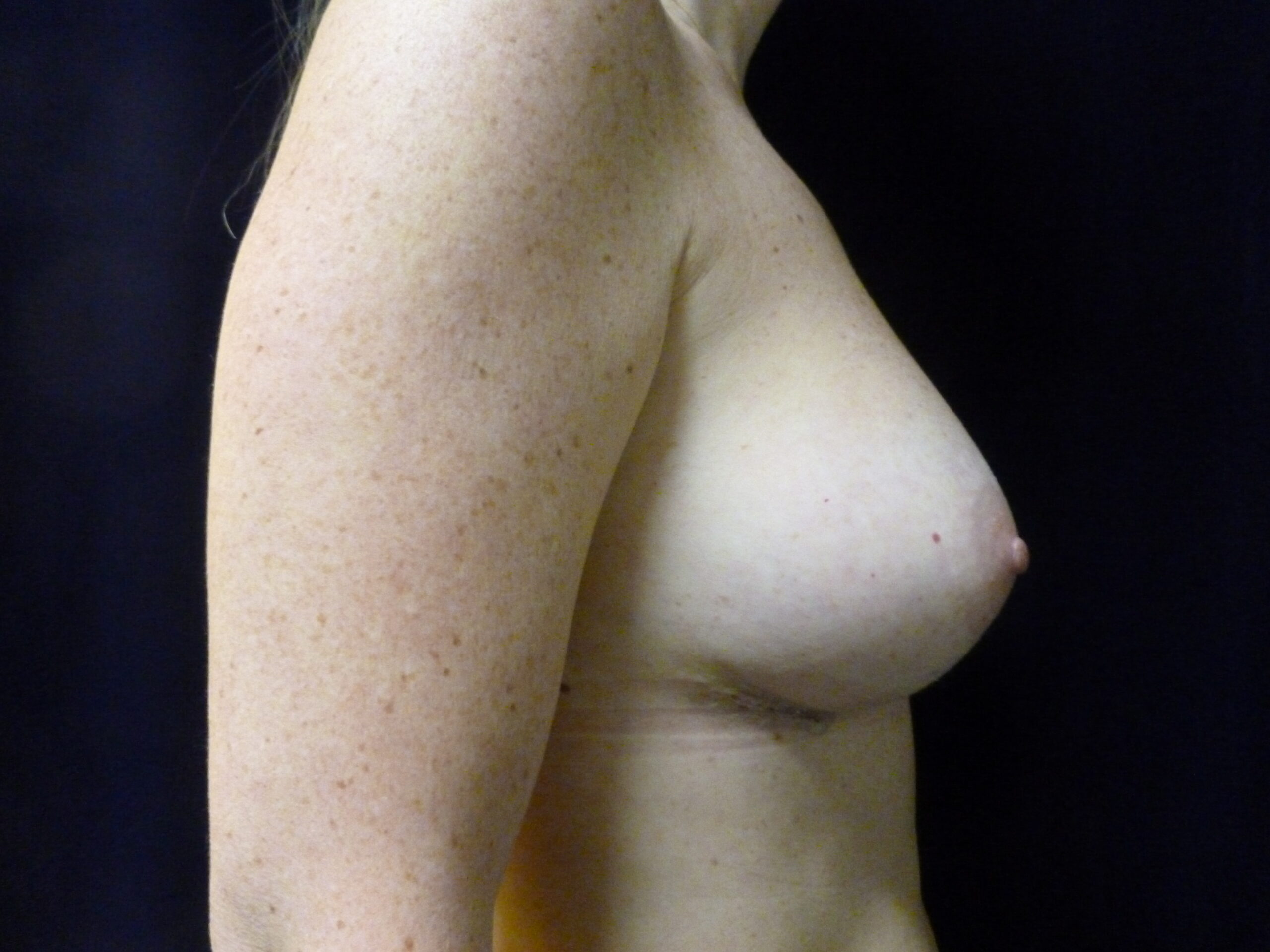 Breast Augmentation Patient Photo - Case 2252 - after view
