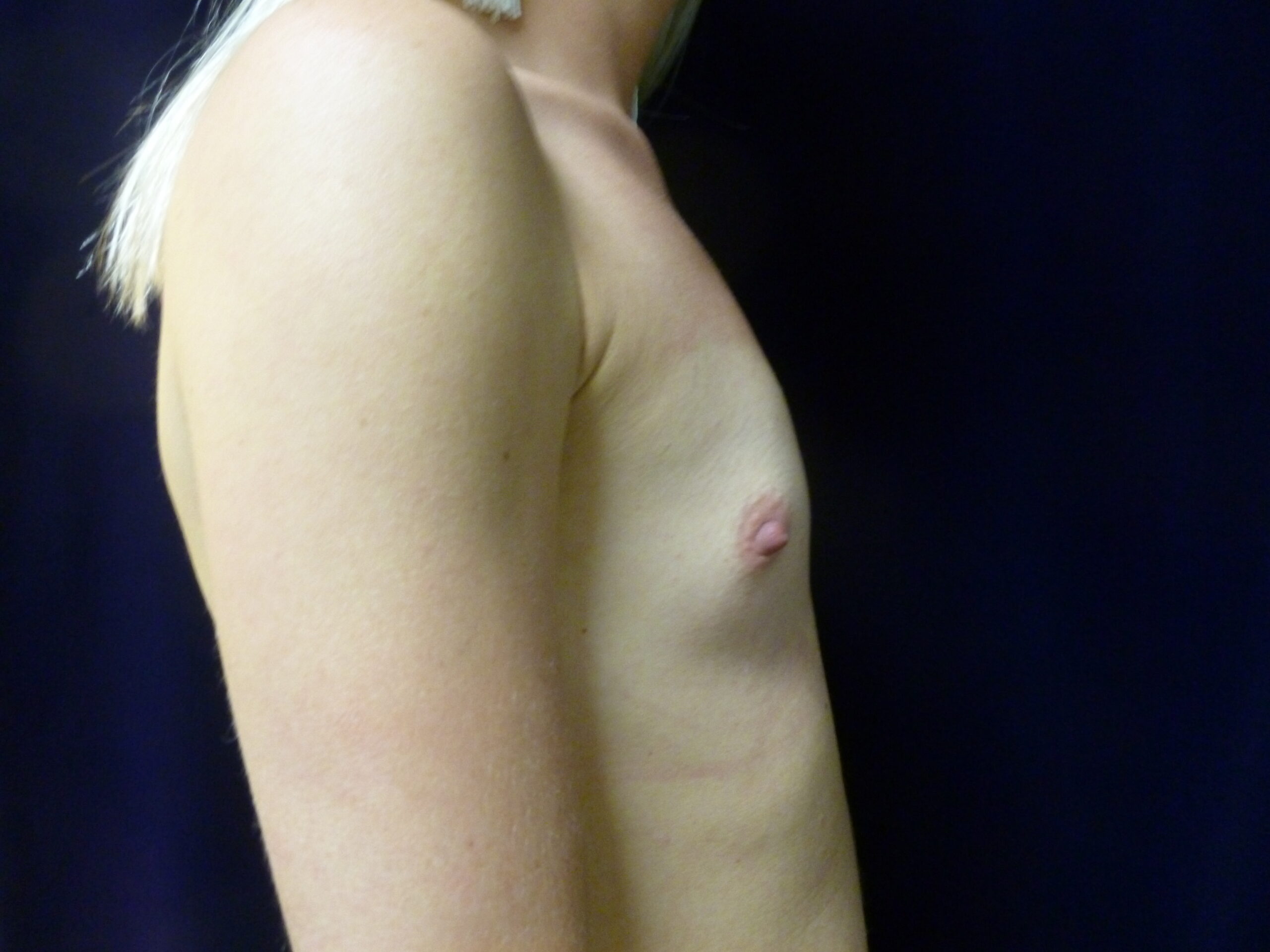 Breast Augmentation Patient Photo - Case 2266 - before view-1
