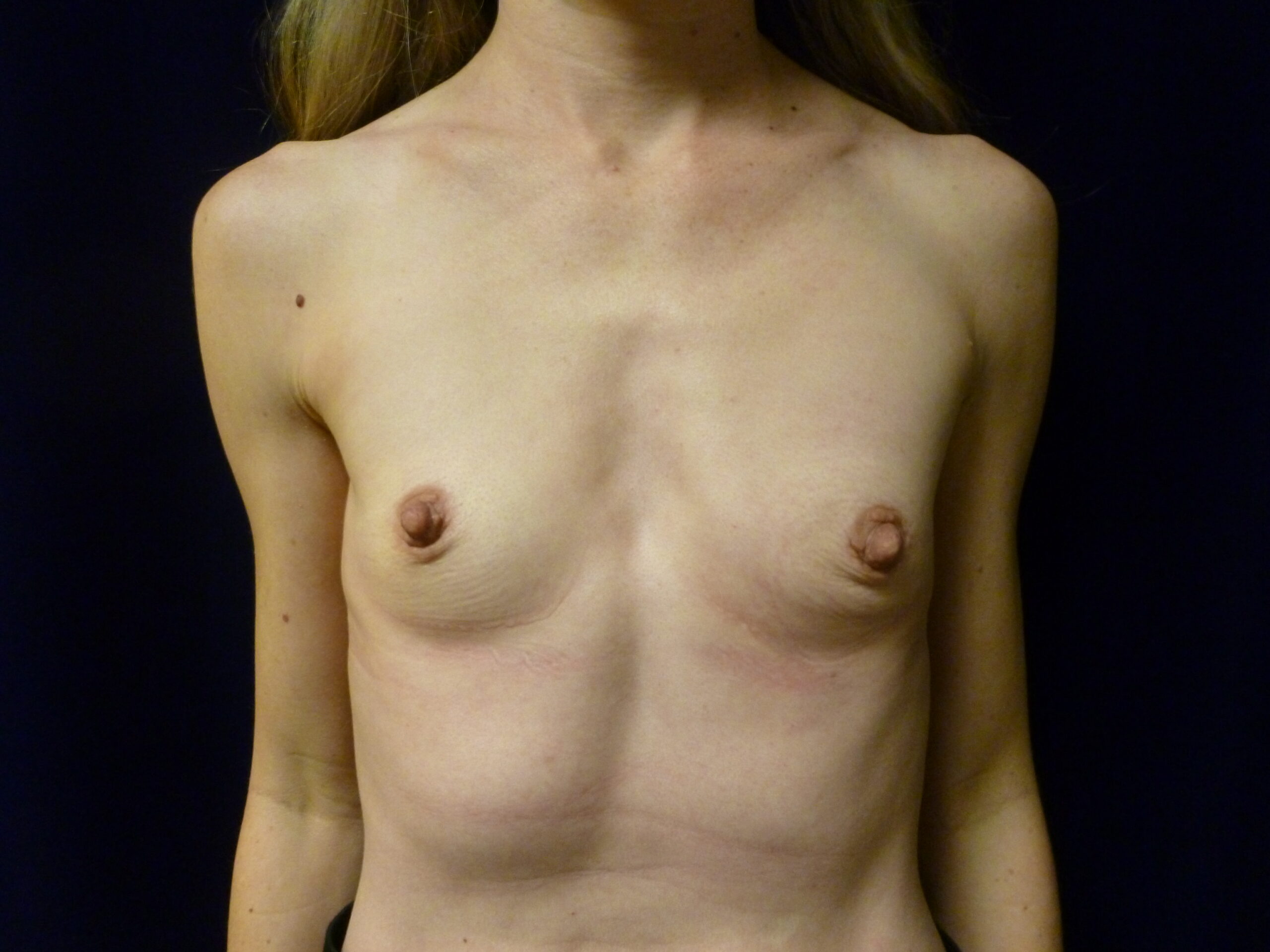 Breast Augmentation Patient Photo - Case 2276 - before view-