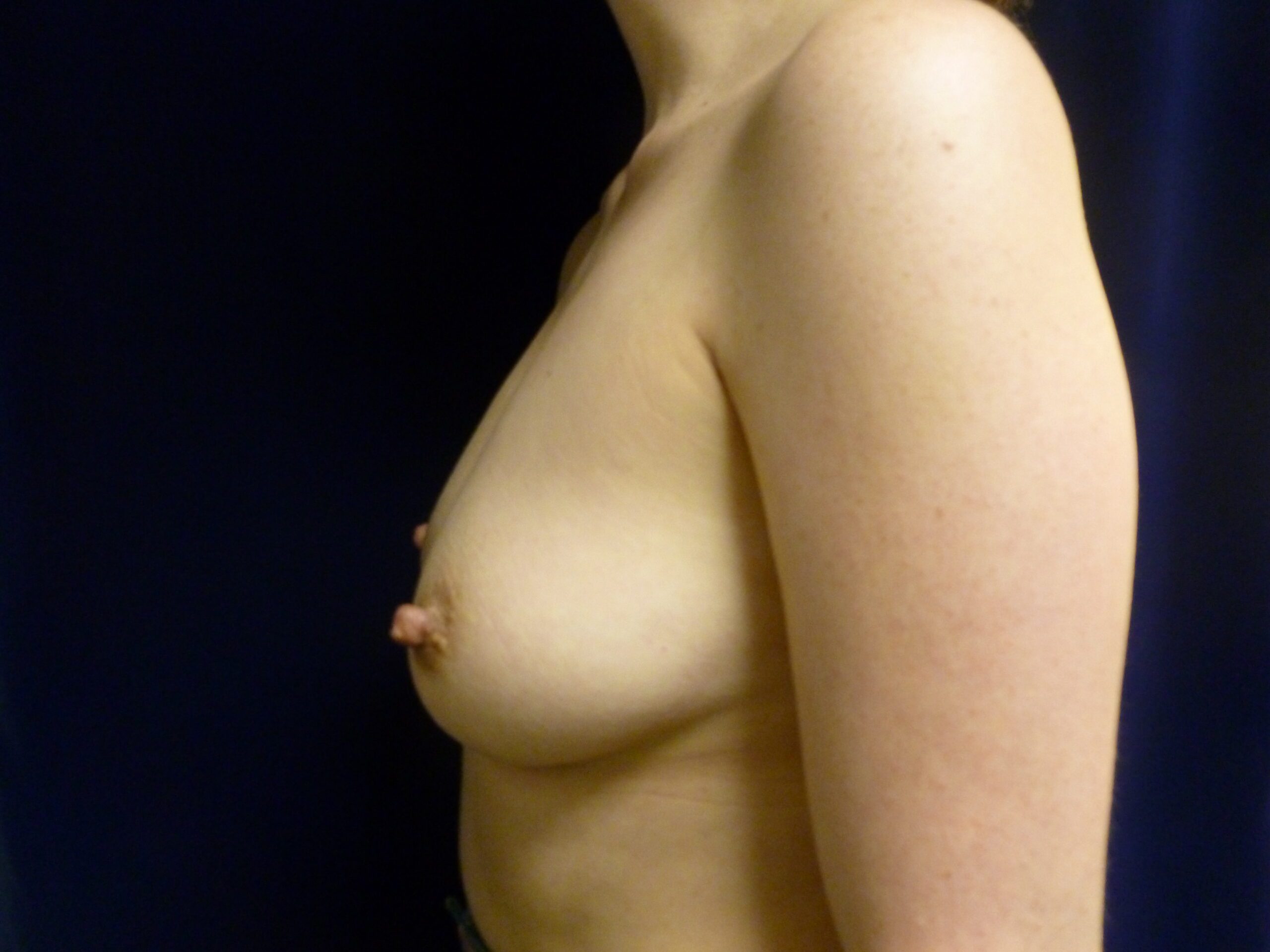 Breast Augmentation Patient Photo - Case 2283 - before view-1