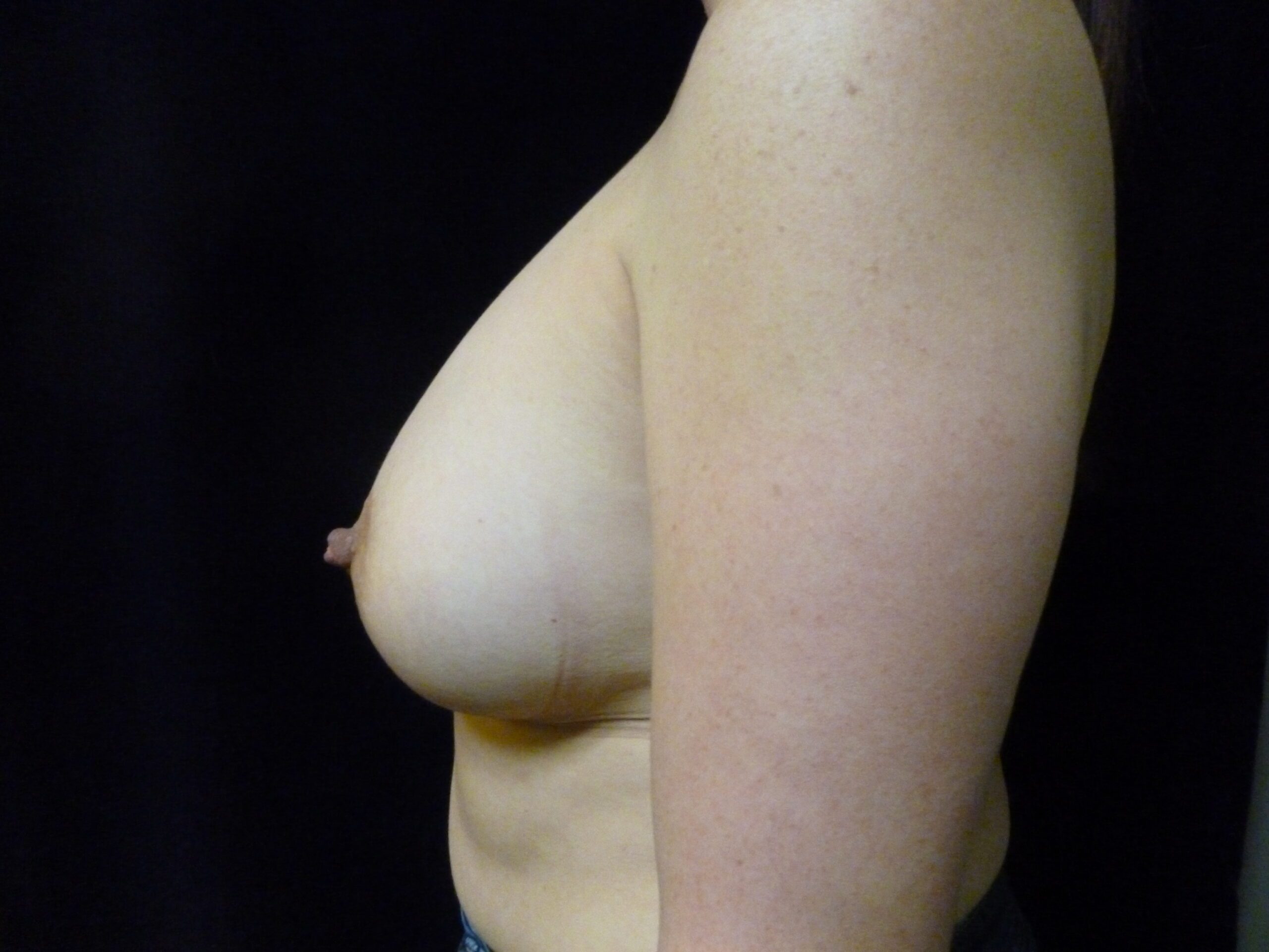 Breast Augmentation Patient Photo - Case 2283 - after view-1