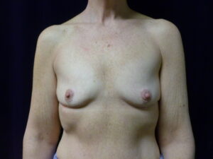 Breast Augmentation - Case 2309 - Before